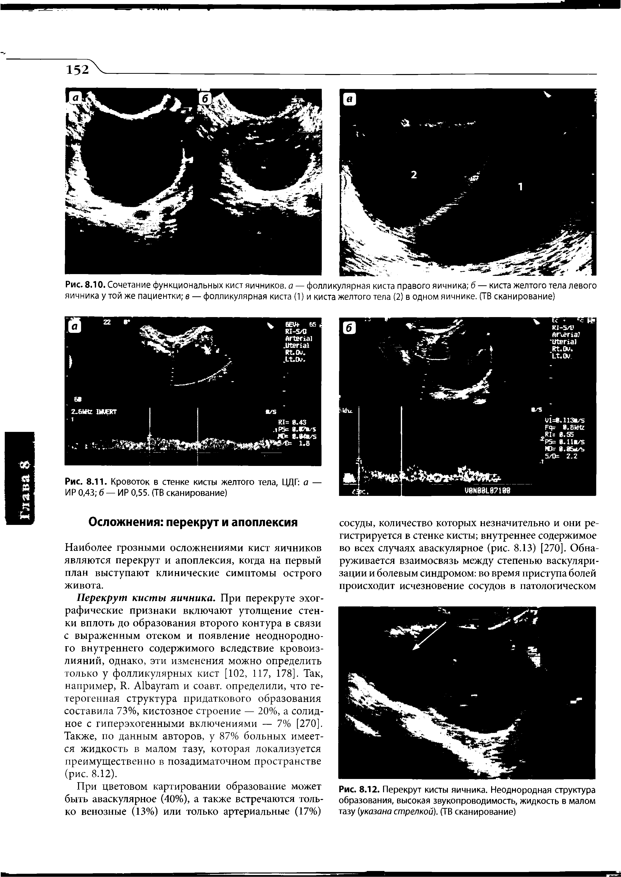 Рис. 8.10. Сочетание функциональных кист яичников, а — фолликулярная киста правого яичника б — киста желтого тела левого яичника у той же пациентки в — фолликулярная киста (1) и киста желтого тела (2) в одном яичнике. (ТВ сканирование)...