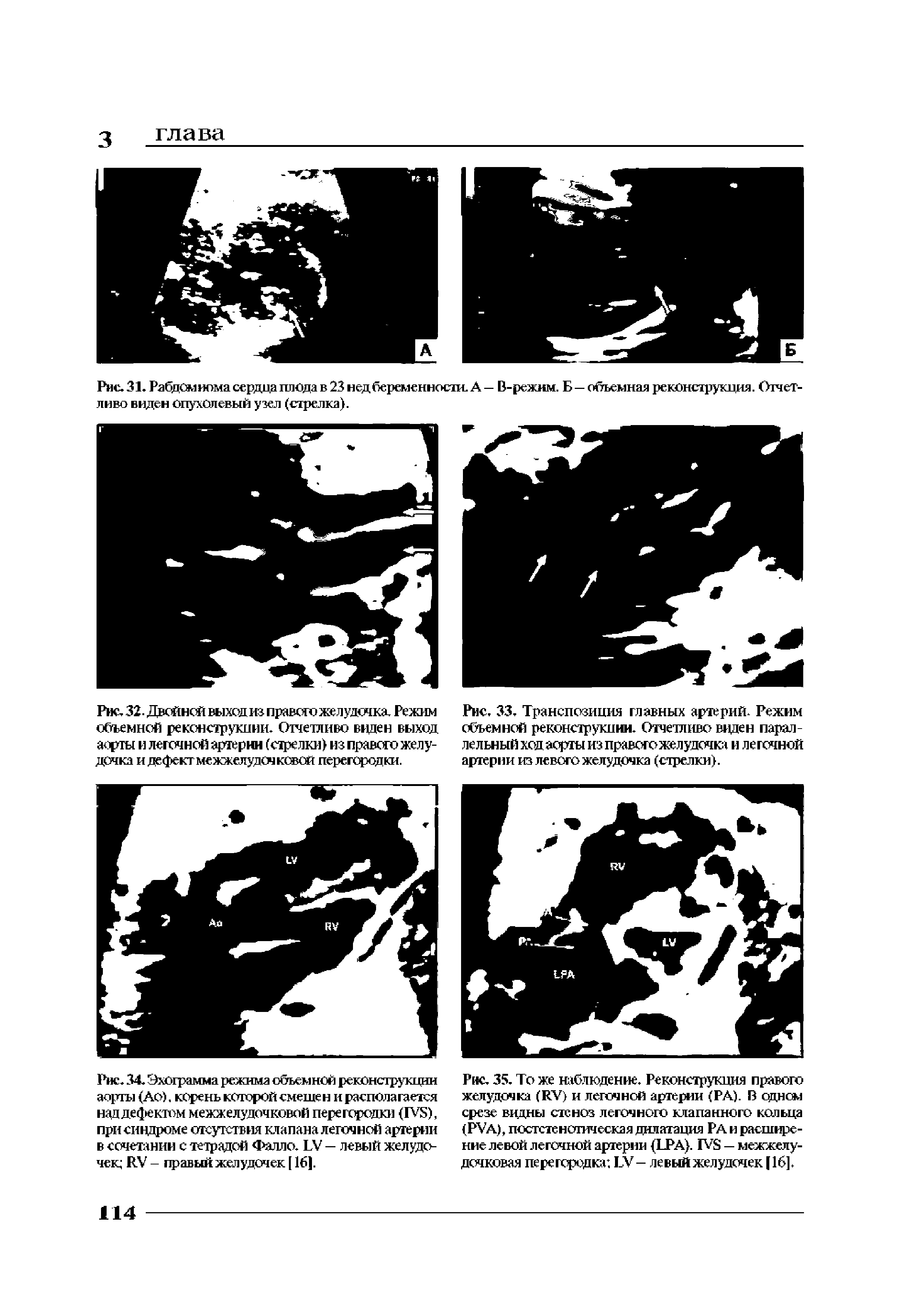 Рис. 35. То же наблюдение. Реконструкция правого желудочка (RV) и легочной артерии (РА). В одном срезе видны стеноз легочного клапанного кольца (PVA), постстеногическая дилатация РА и расширение левой легочной артерии (LPA). IVS — межжелудочковая перегородка БУ - ле вый желудочек ] 16].
