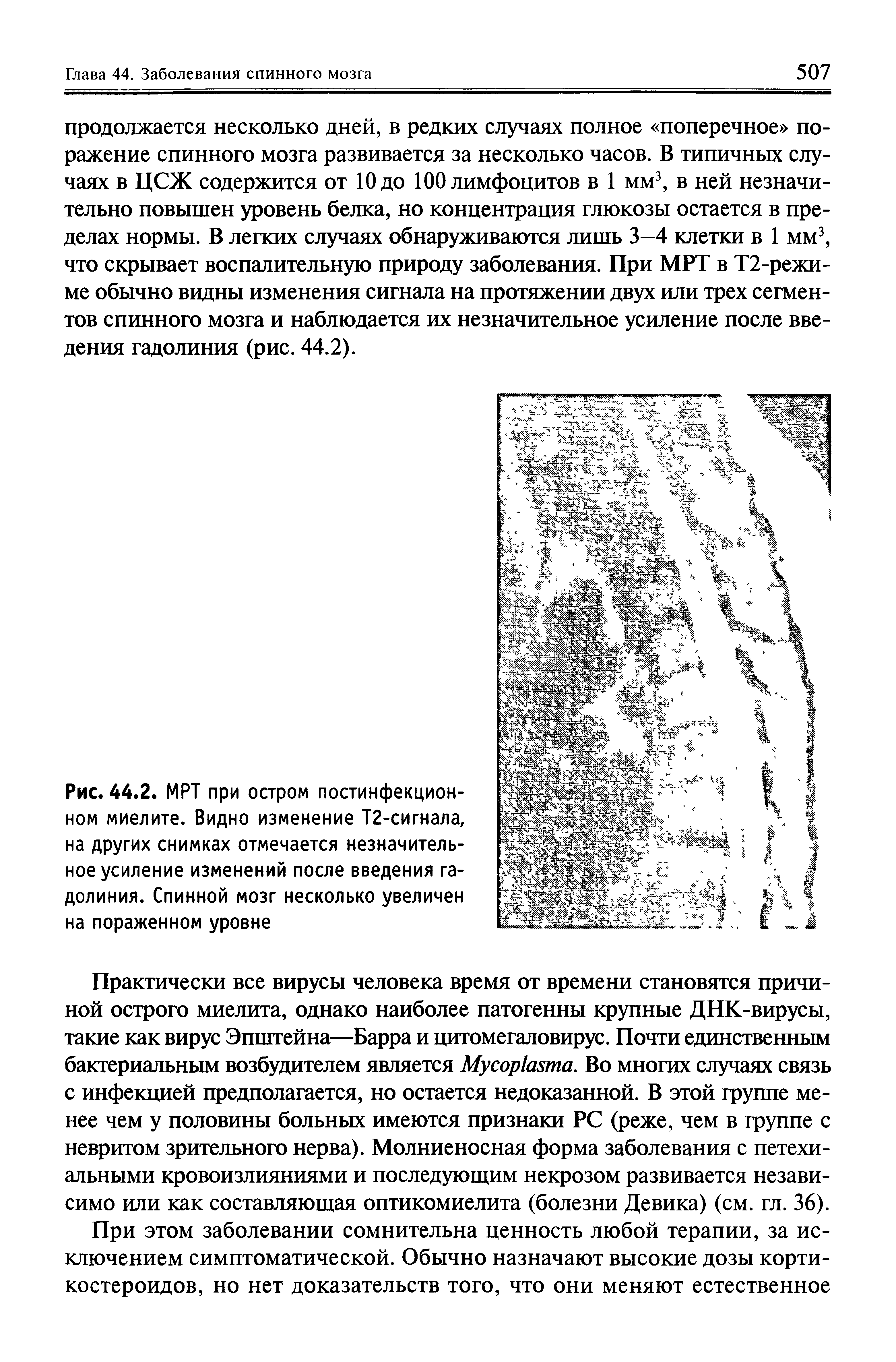 Рис. 44.2. МРТ при остром постинфекционном миелите. Видно изменение Т2-сигнала, на других снимках отмечается незначительное усиление изменений после введения гадолиния. Спинной мозг несколько увеличен на пораженном уровне...