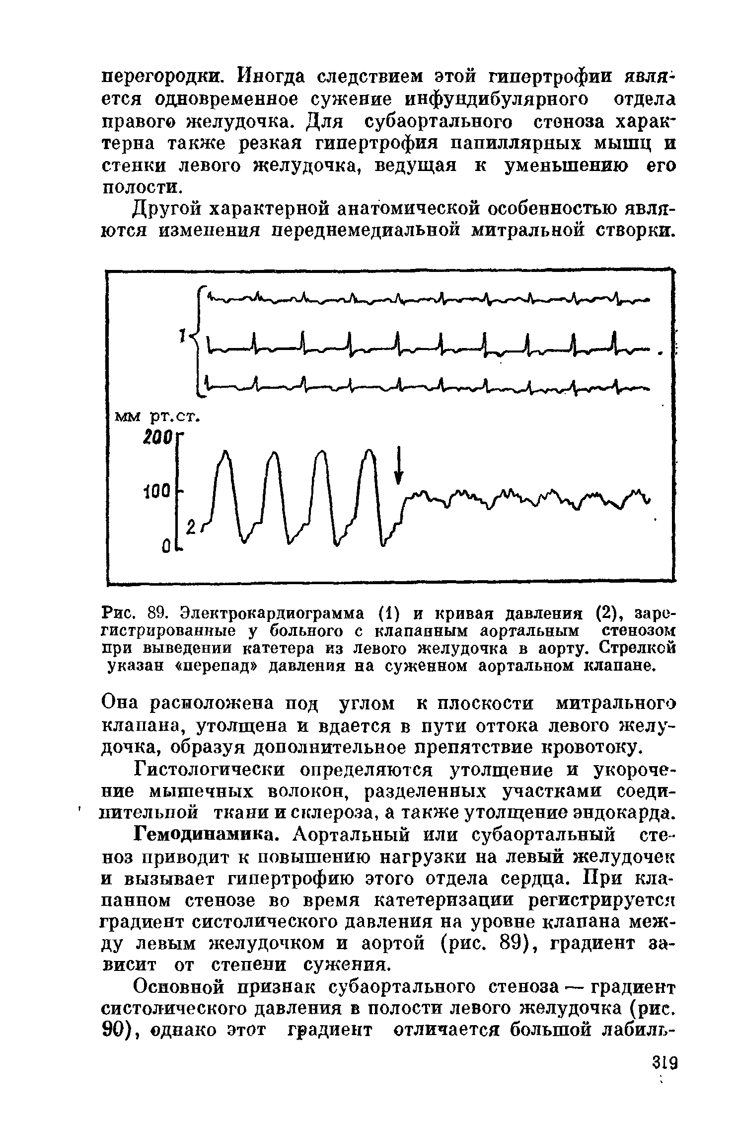 Рис. 89. Электрокардиограмма (1) и кривая давления (2), зарегистрированные у больного с клапанным аортальным стенозом при выведении катетера из левого желудочка в аорту. Стрелкой указан перепад давления на суженном аортальном клапане.