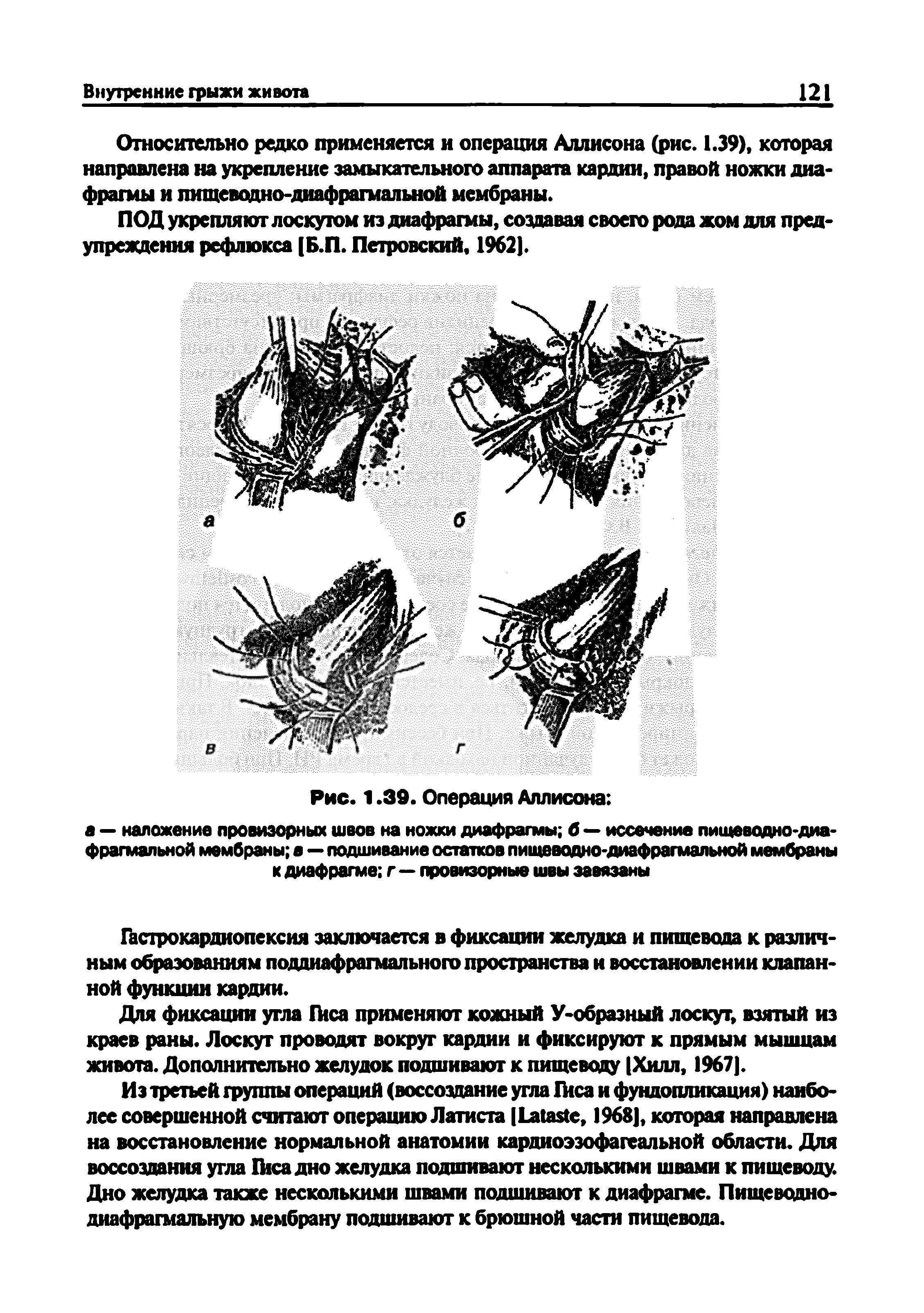 Рис. 1.39. Операция Аллисона а — наложение провизорных швов на ножки диафрагмы б — иссечение пищеводно-диафрагмальной мембраны в—подшивание остатков пищвводно-диафрагмальной мембраны к диафрагме г — провизорные швы завязаны...