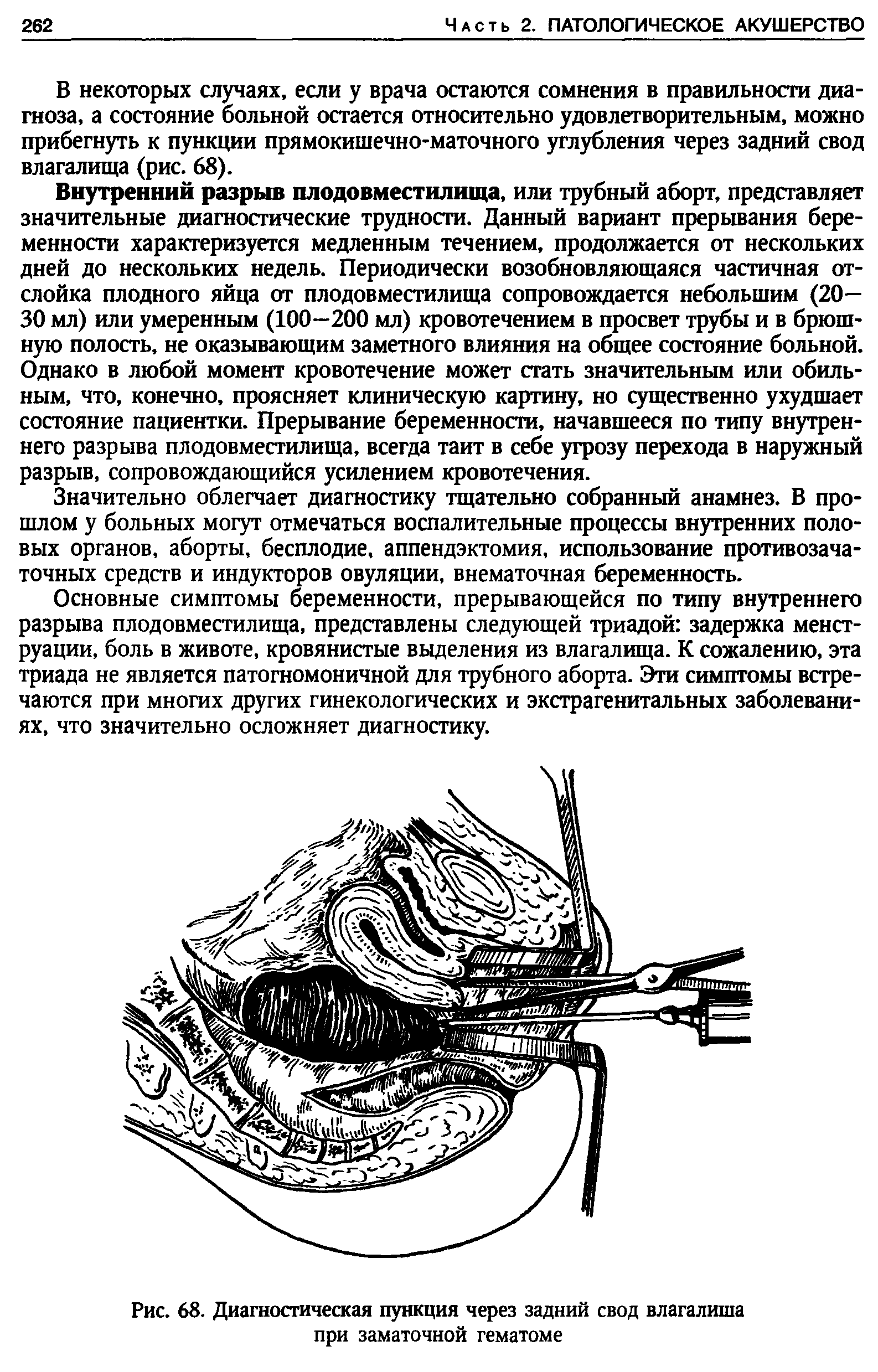 Рис. 68. Диагностическая пункция через задний свод влагалища при заматочной гематоме...