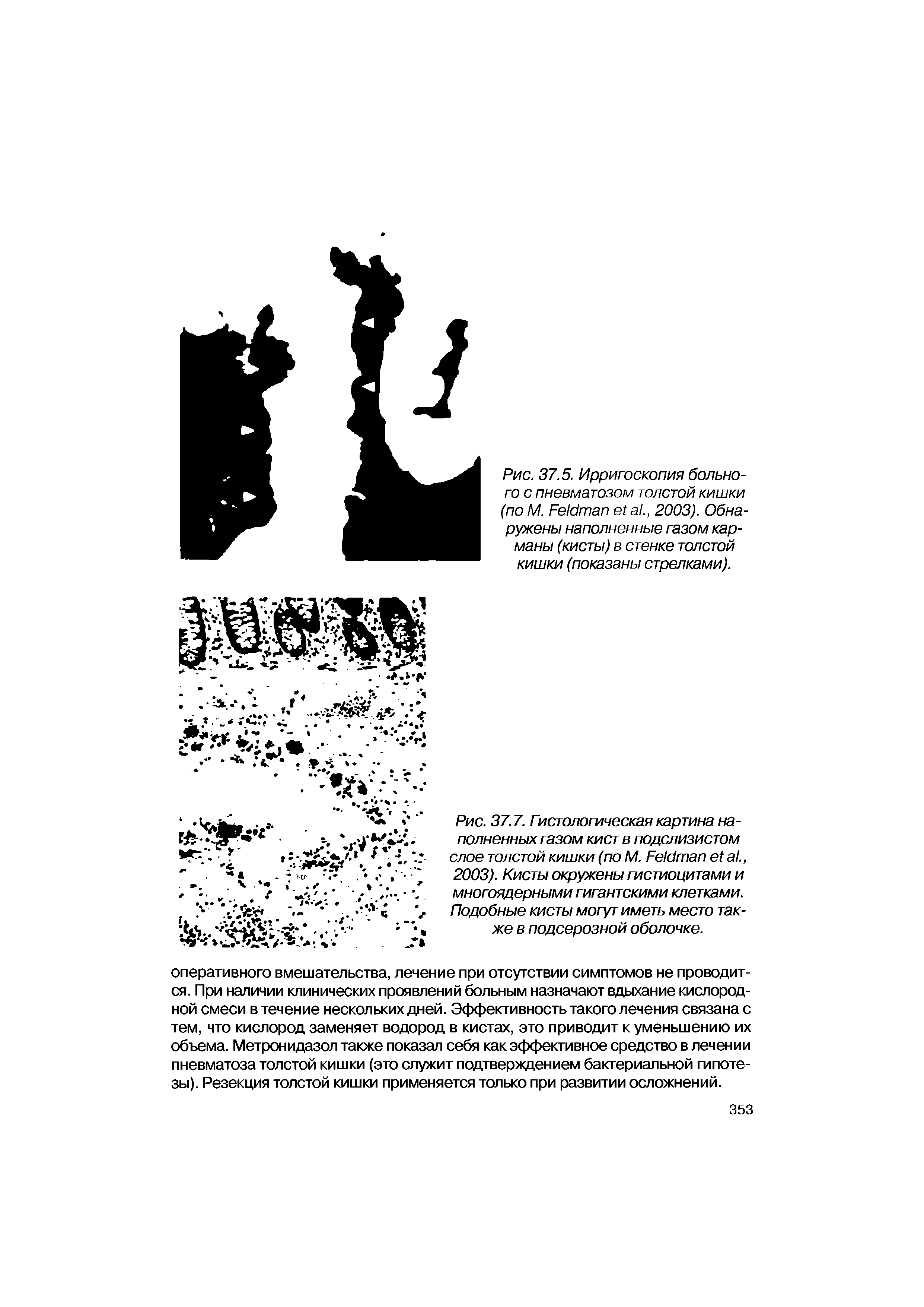 Рис. 37.5. Ирригоскопия больного с пневматозом толстой кишки (по М. F ., 2003). Обнаружены наполненные газом карманы (кисты) в стенке толстой кишки (показаны стрелками).