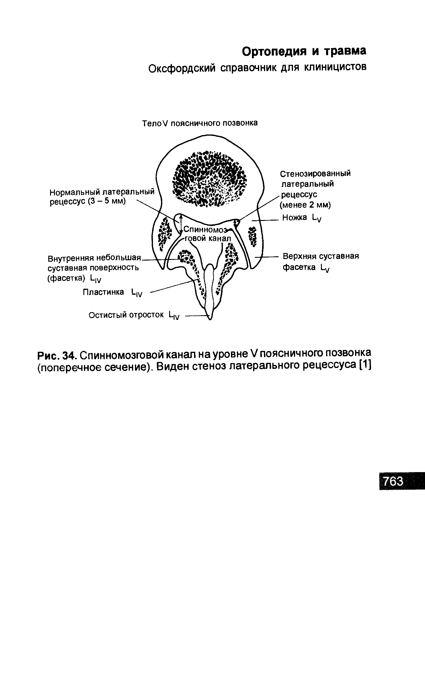 Рис. 34. Спинномозговой канал на уровне V поясничного позвонка (поперечное сечение). Виден стеноз латерального рецессуса [1]...
