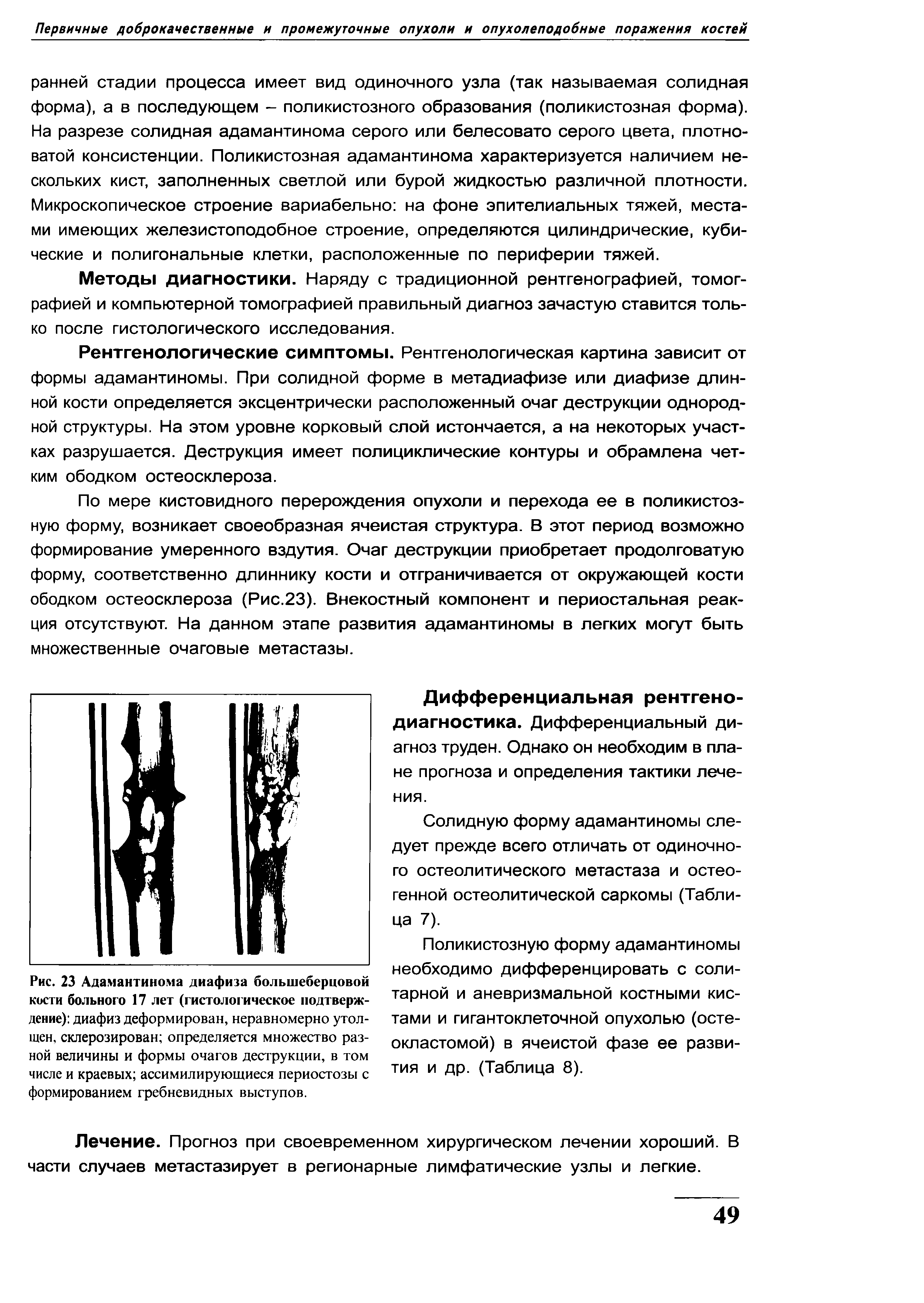 Рис. 23 Адамантинома диафиза большеберцовой кости больного 17 лет (гистологическое подтверждение) диафиз деформирован, неравномерно утолщен, склерозирован определяется множество разной величины и формы очагов деструкции, в том числе и краевых ассимилирующиеся периостозы с формированием гребневидных выступов.