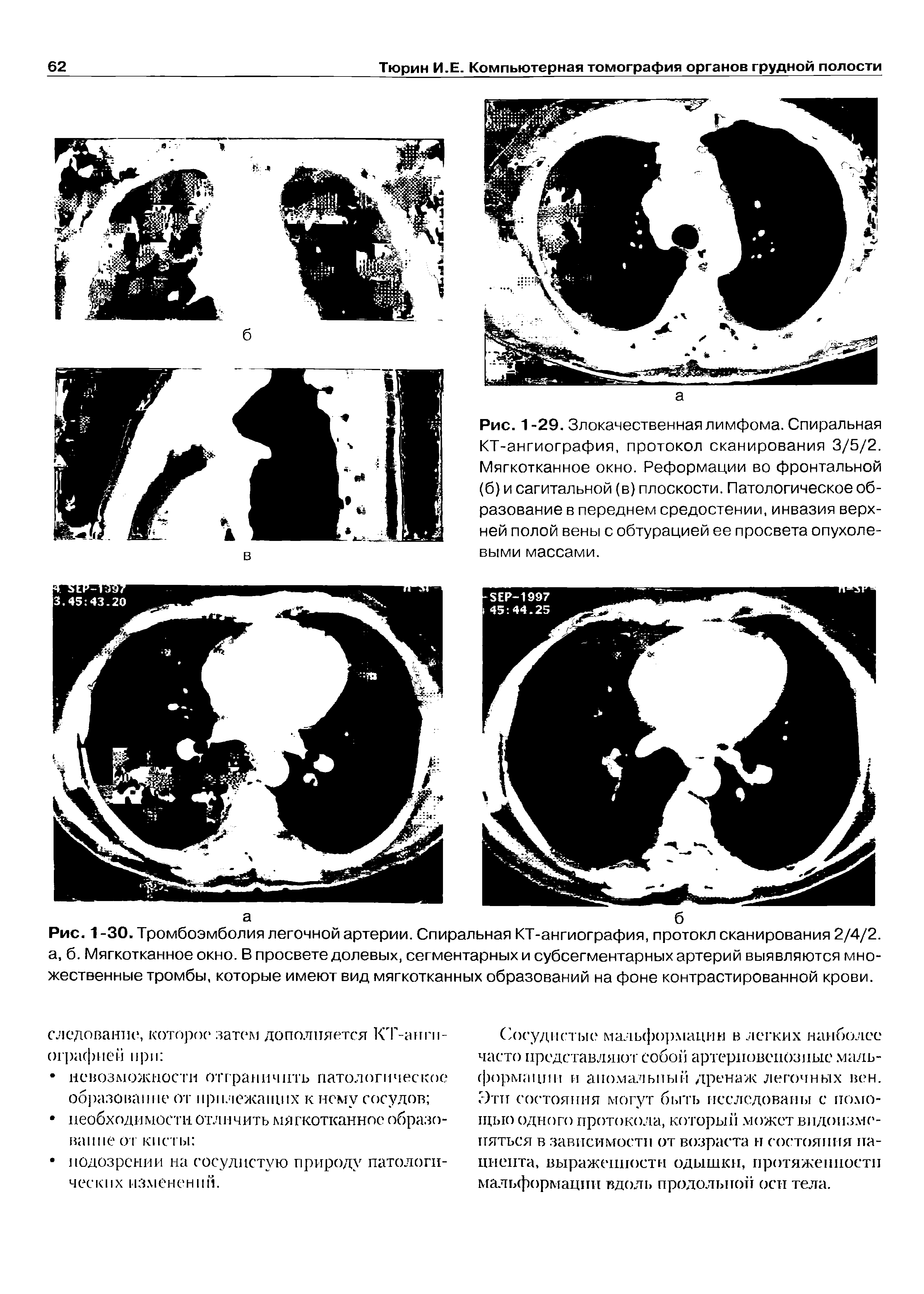 Рис. 1 -30. Тромбоэмболия легочной артерии. Спиральная КТ-ангиография, протокл сканирования 2/4/2. а, б. Мягкотканное окно. В просвете долевых, сегментарных и субсегментарных артерий выявляются множественные тромбы, которые имеют вид мягкотканных образований на фоне контрастированной крови.