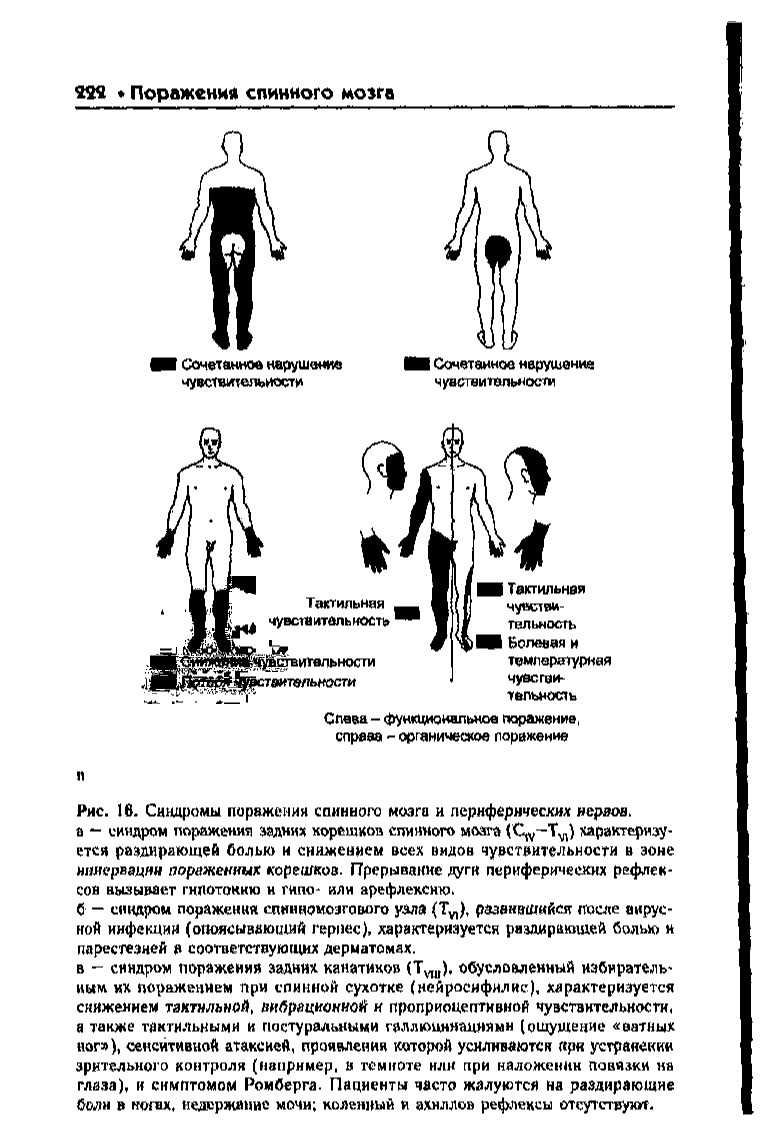 Рис. 16. Синдромы поражения спинного мозга и периферических нервов.