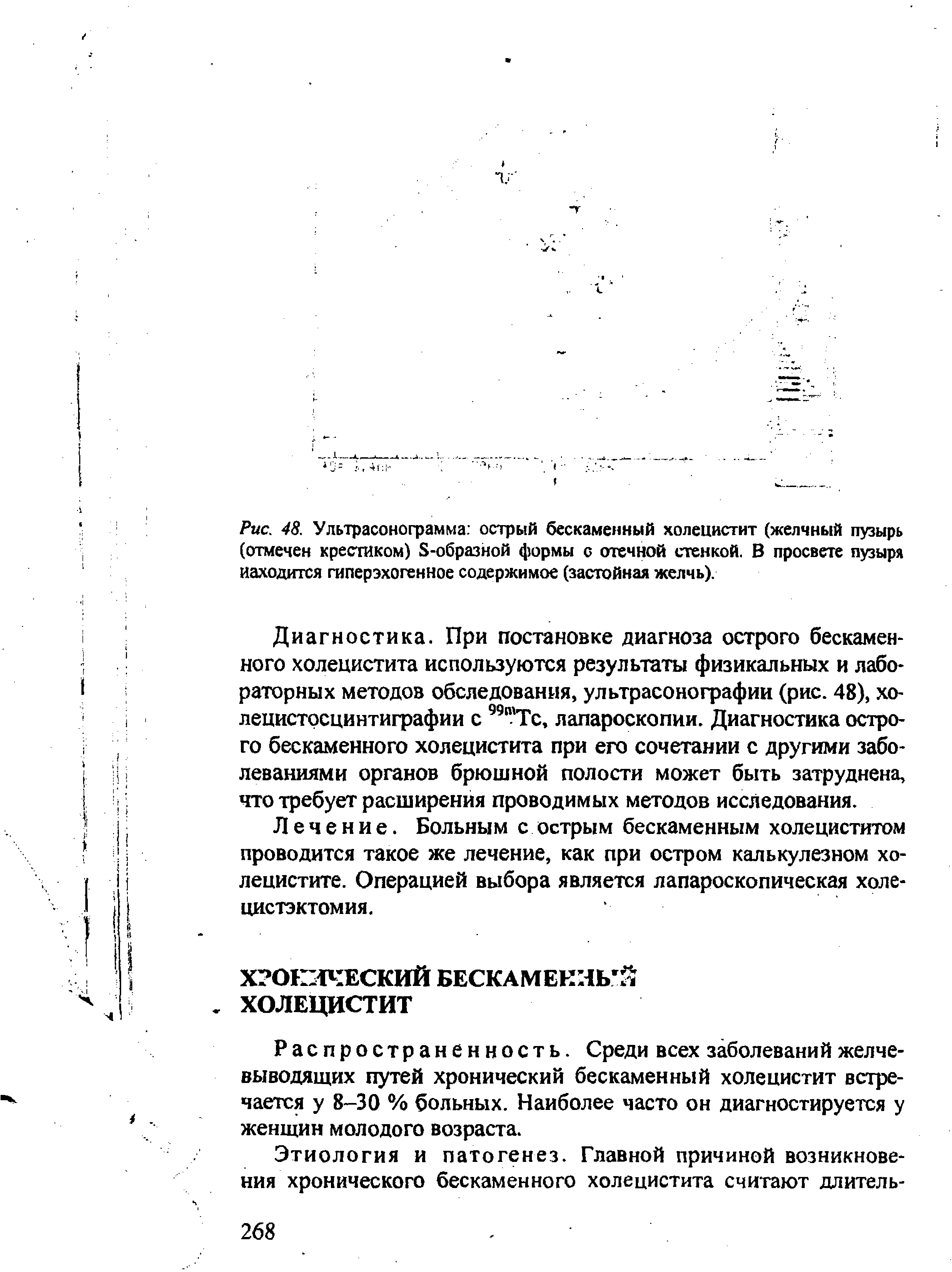 Рис. 48. Ультрасонограмма острый бескаменный холецистит (желчный пузырь (отмечен крестиком) 8-образной формы о отечной стенкой. В просвете пузыря находится гиперэхогенное содержимое (застойная желчь).