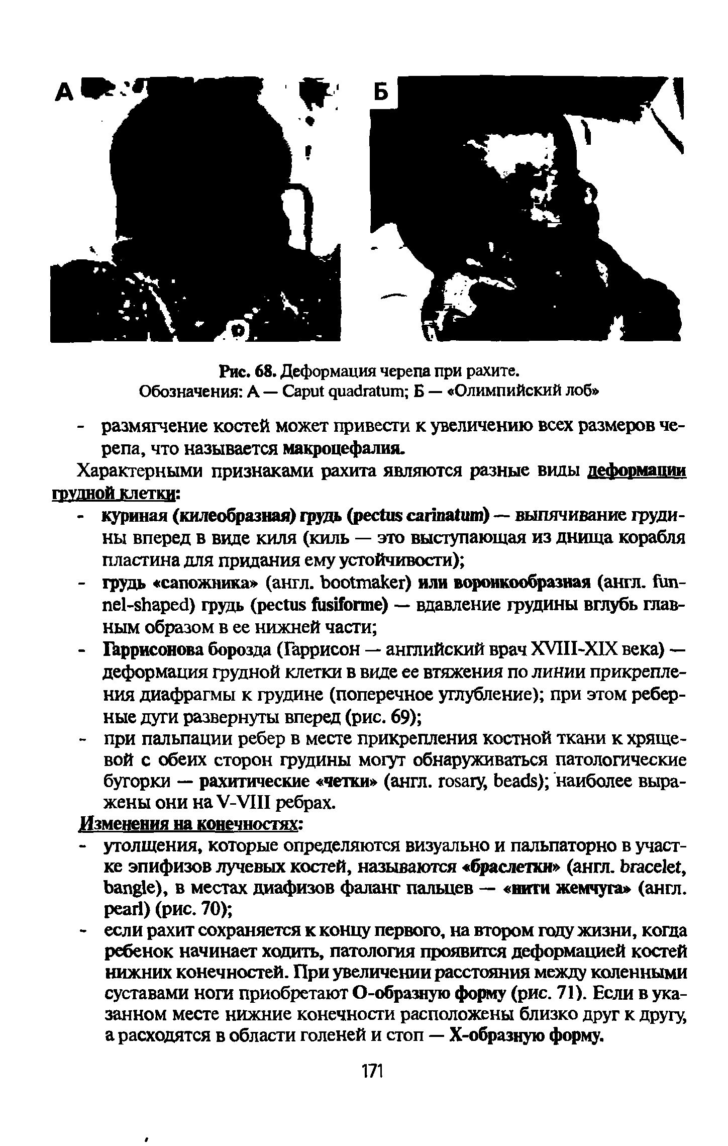 Рис. 68. Деформация черепа при рахите. Обозначения А — C Б — Олимпийский лоб ...