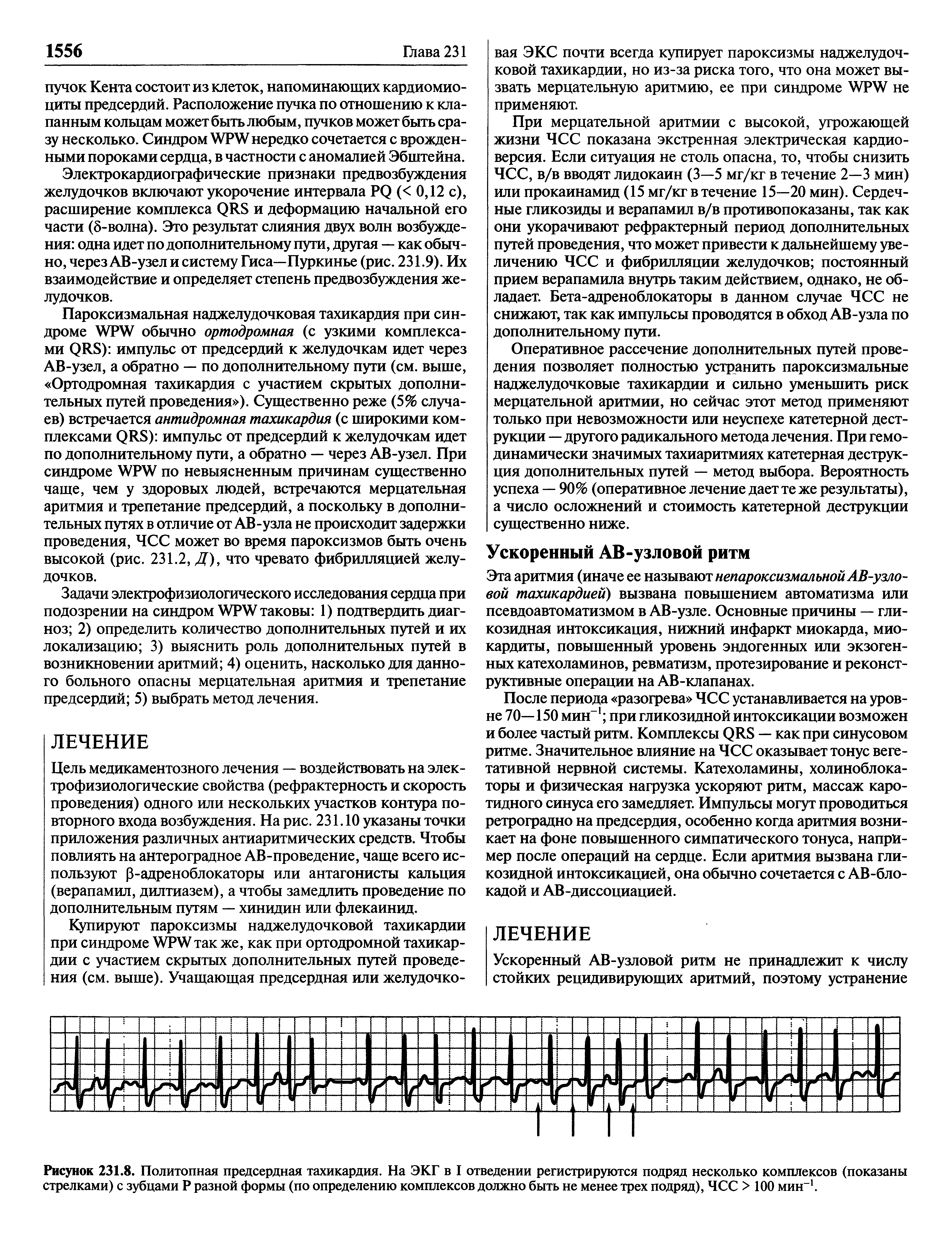 Рисунок 231.8. Политопная предсердная тахикардия. На ЭКГ в I отведении регистрируются подряд несколько комплексов (показаны стрелками) с зубцами Р разной формы (по определению комплексов должно быть не менее трех подряд), ЧСС > 100 мин-1.