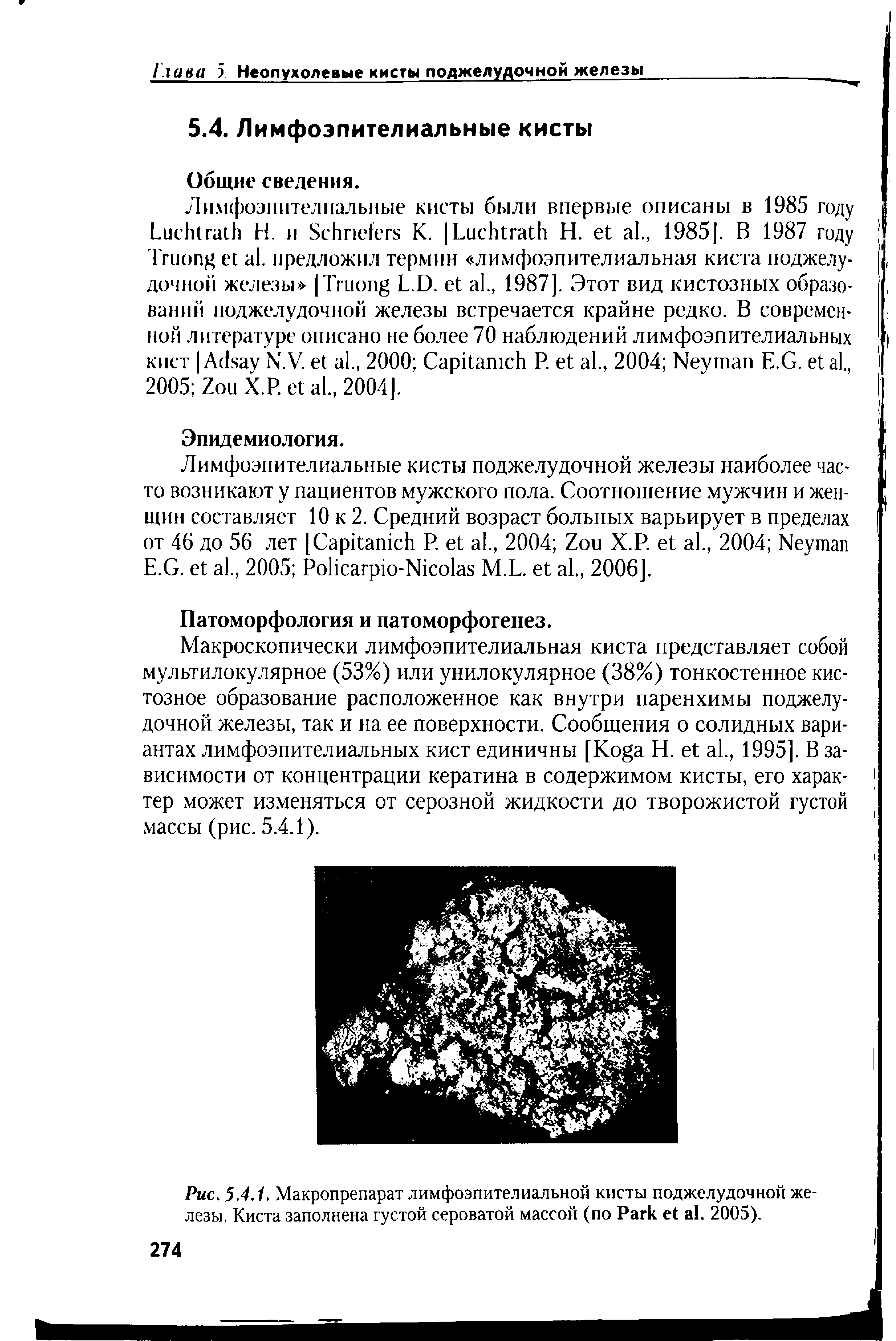 Рис. 5.4. Г Макропрепарат лимфоэпителиальной кисты поджелудочной железы. Киста заполнена густой сероватой массой (по P . 2005).