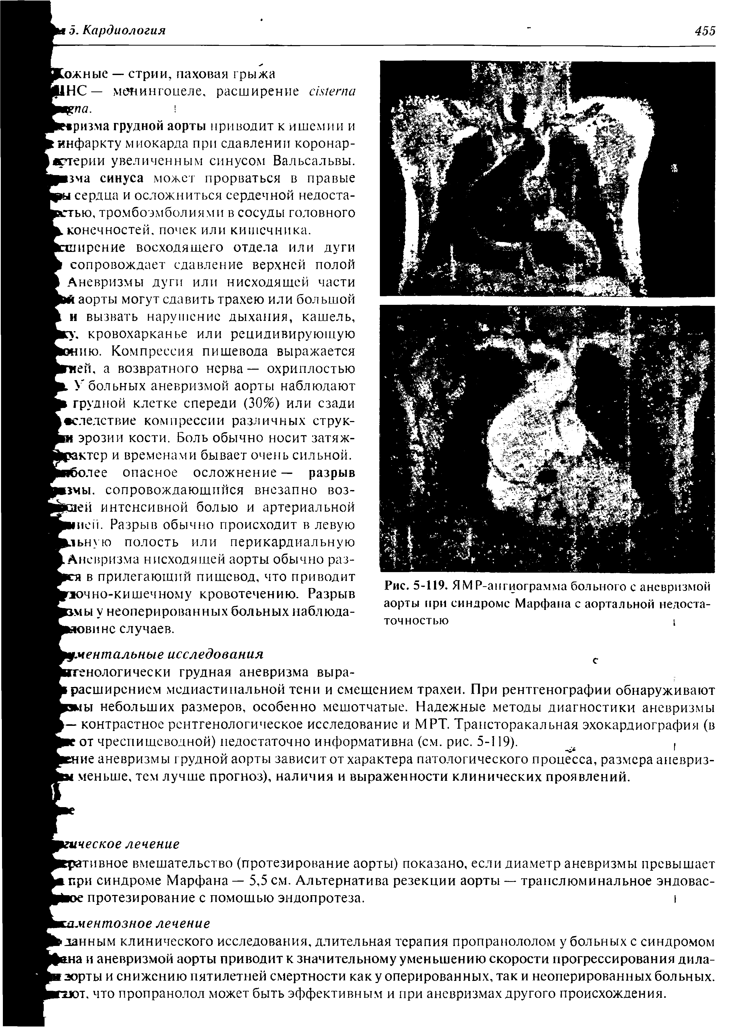 Рис. 5-119. ЯМР-ангиограмма больного с аневризмой аорты при синдроме Марфана с аортальной недоста-...