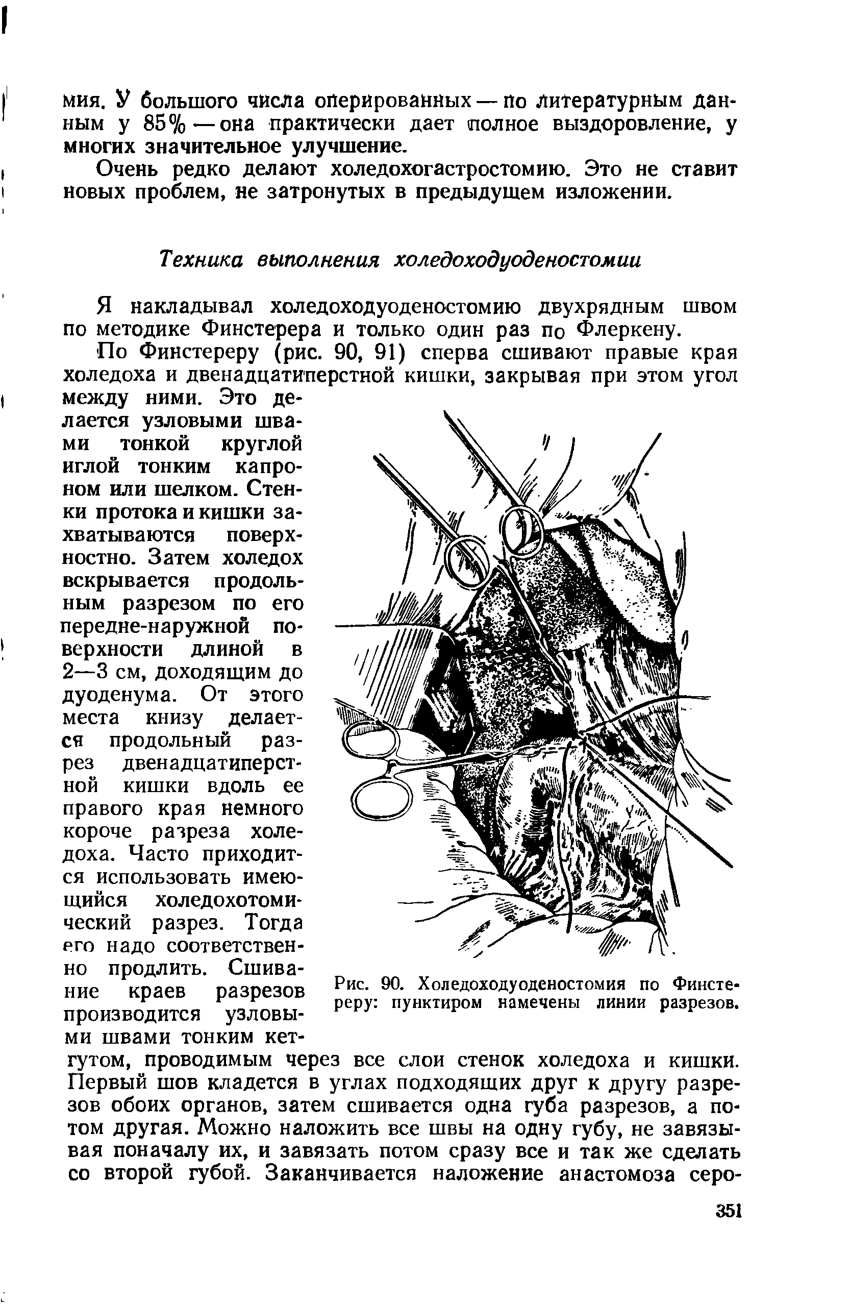 Рис. 90. Холедоходуоденостомия по Финстереру пунктиром намечены линии разрезов.