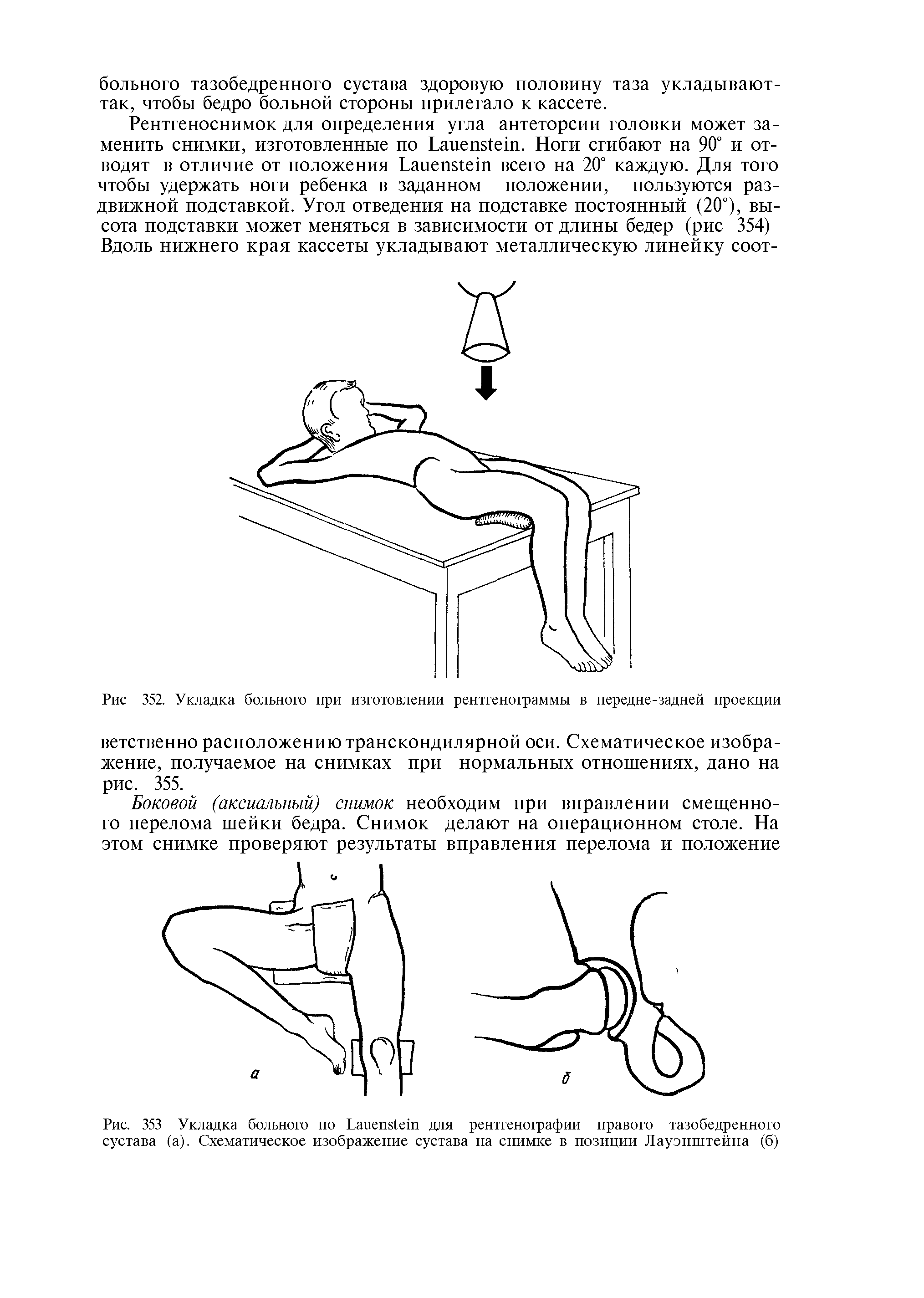 Рис. 353 Укладка больного по Раиеп81ет для рентгенографии правого тазобедренного сустава (а). Схематическое изображение сустава на снимке в позиции Лауэнштейна (б)...