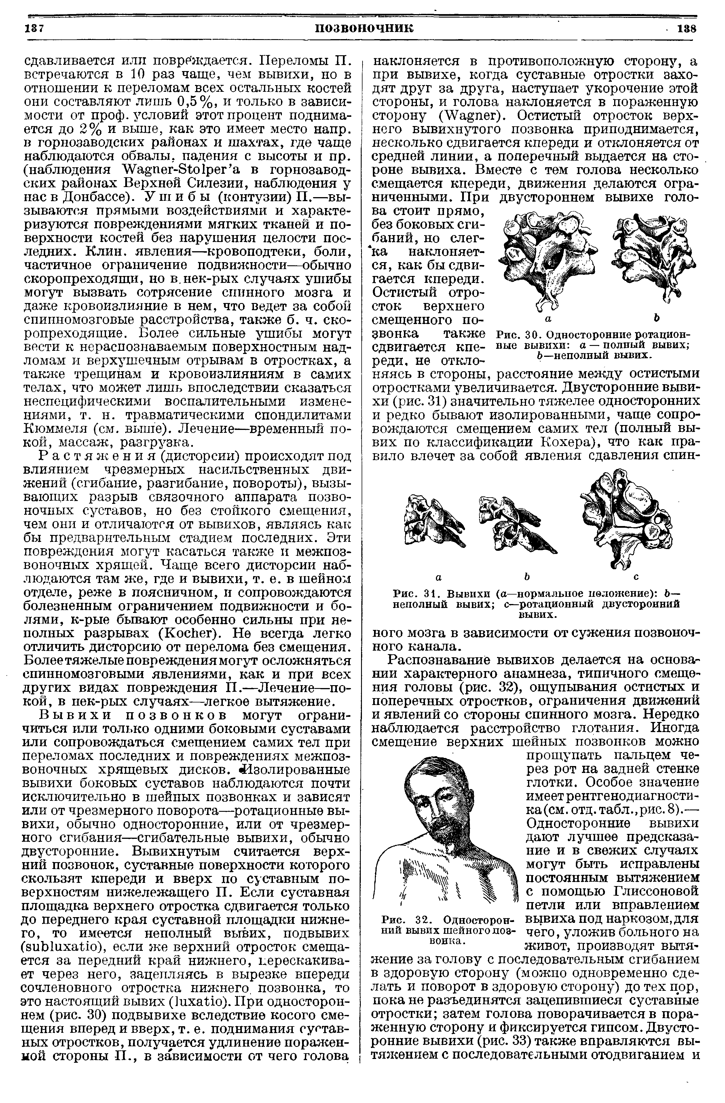 Рис. 31. Вывихи (а—нормальное положение) Ь— неполный вывих с—ротационный двусторонний вывих.