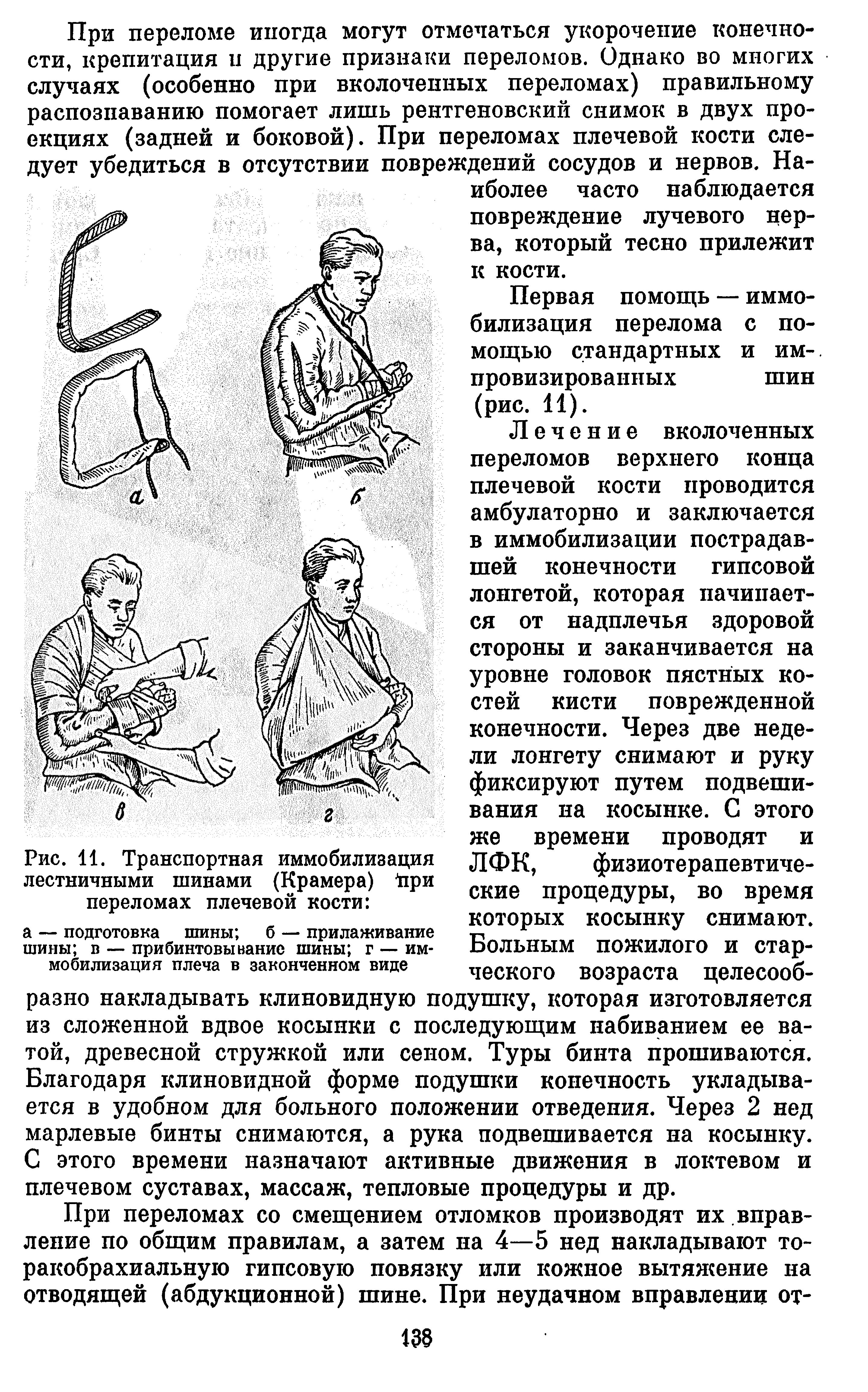 Рис. 11. Транспортная иммобилизация лестничными шинами (Крамера) Дри переломах плечевой кости ...