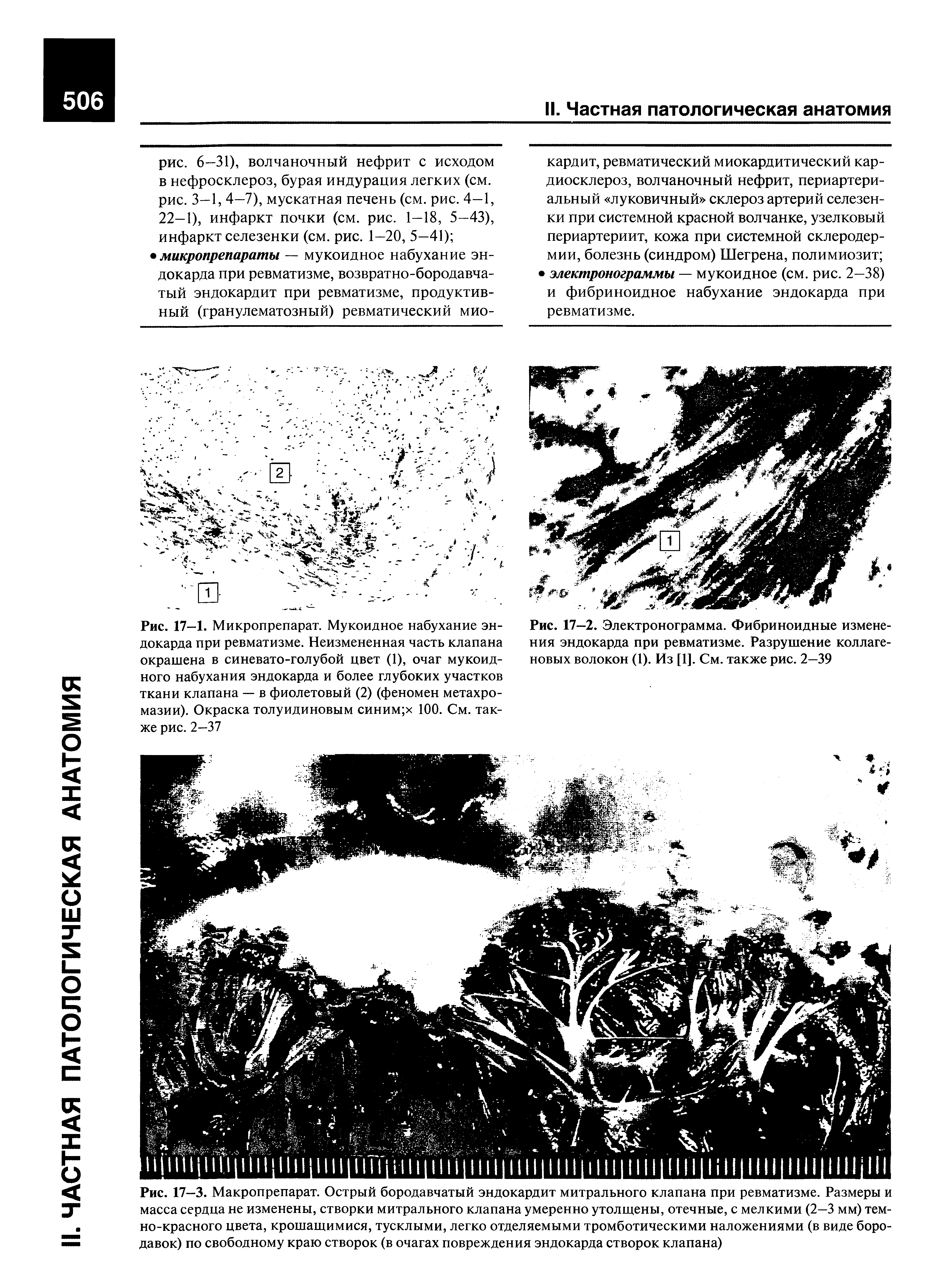 Рис. 17—1. Микропрепарат. Мукоидное набухание эндокарда при ревматизме. Неизмененная часть клапана окрашена в синевато-голубой цвет (1), очаг мукоидного набухания эндокарда и более глубоких участков ткани клапана — в фиолетовый (2) (феномен метахромазии). Окраска толуидиновым синим х 100. См. также рис. 2—37...