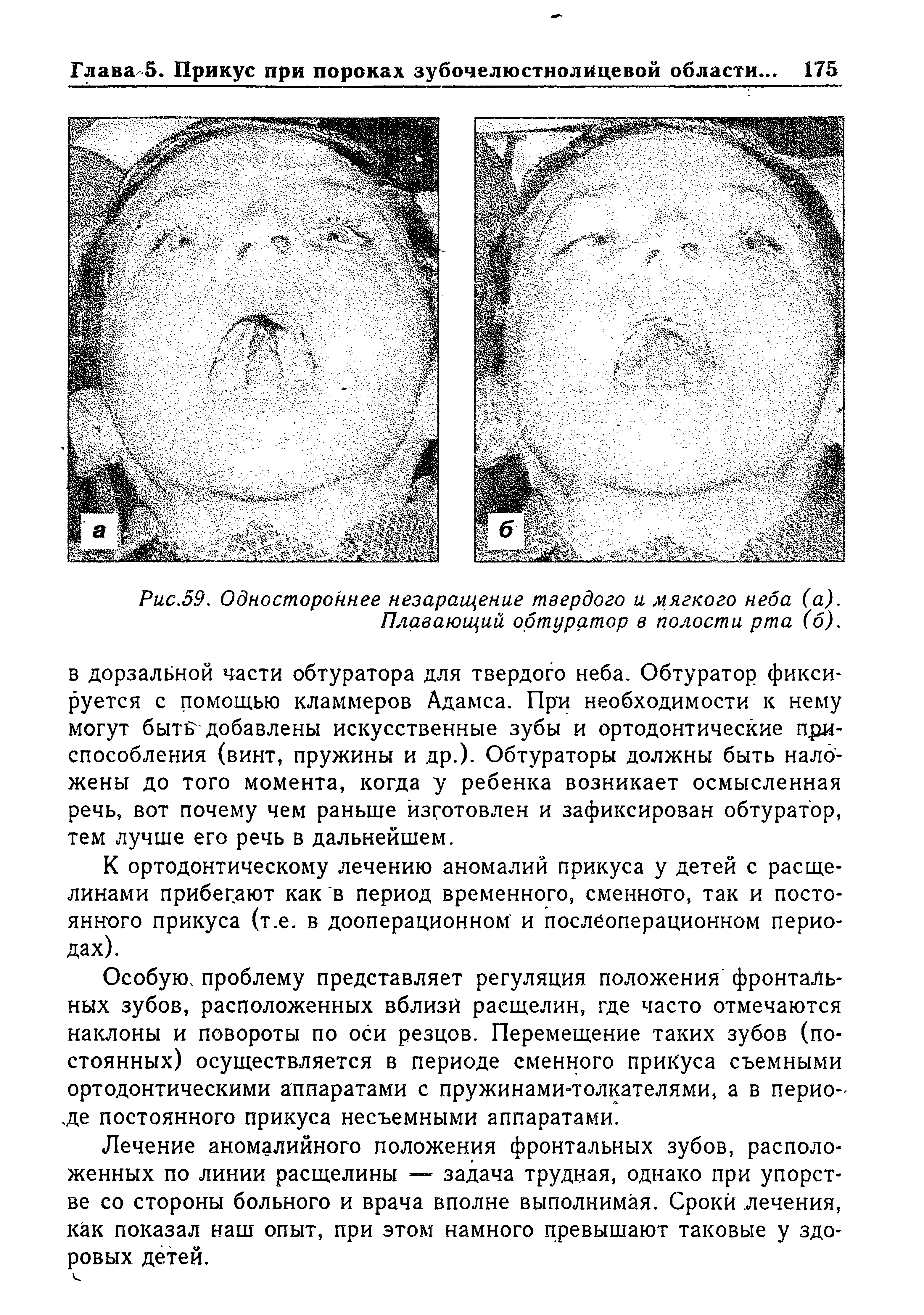 Рис.59. Одностороннее незаращение твердого и мягкого неба (а). Плавающий обтуратор в полости рта (б).