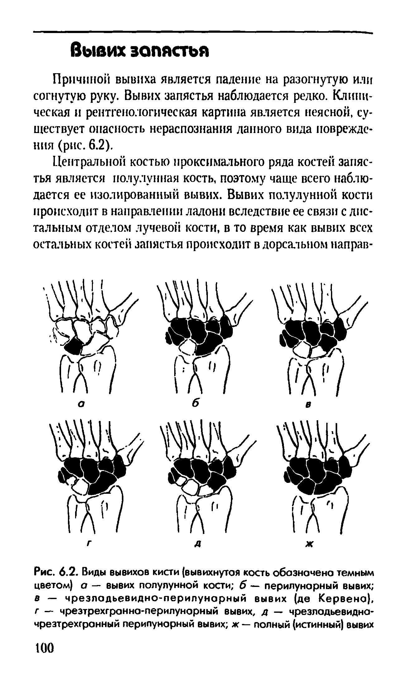 Рис. 6.2. Виды вывихов кисти (вывихнутая кость обозночено темным цветом) а — вывих полулунной кости б — перилунарный вывих в — чрезлодьевидно-перилунорный вывих (де Кервена), г — чрезтрехгронна-перилунорный вывих, д — чрезладьевидна-чрезтрехгронный перилунарный вывих ж — полный (истинный) вывих...