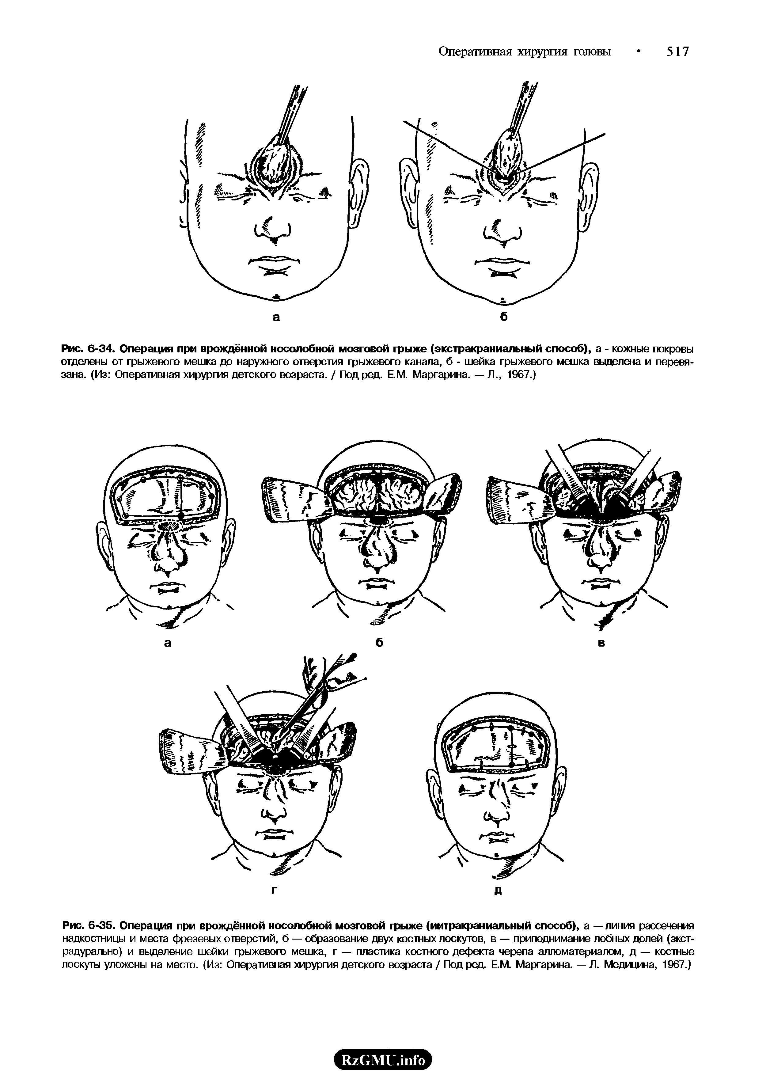 Рис. 6-34. Операция при врождённой носолобной мозговой грыже (экстракраниальный способ), а - кожные покровы отделены от грыжевого мешка до наружного отверстия грыжевого канала, б - шейка грыжевого мешка выделена и перевязана. (Из Оперативная хирургия детского возраста. / Под ред. ЕМ. Маргарина. — Л., 1967.)...