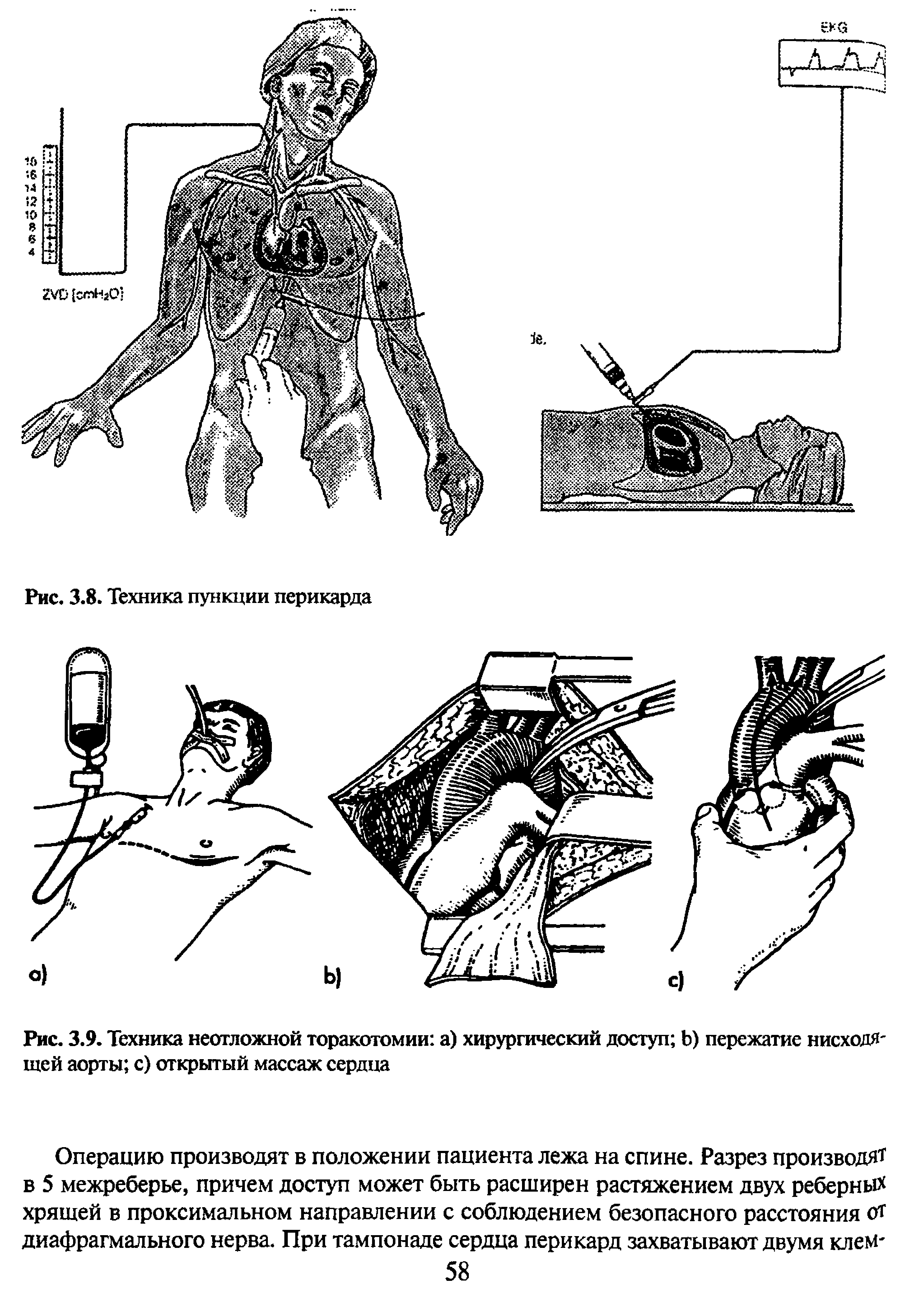 Рис. 3.9. Техника неотложной торакотомии а) хирургический доступ Ь) пережатие нисходящей аорты с) открытый массаж сердца...