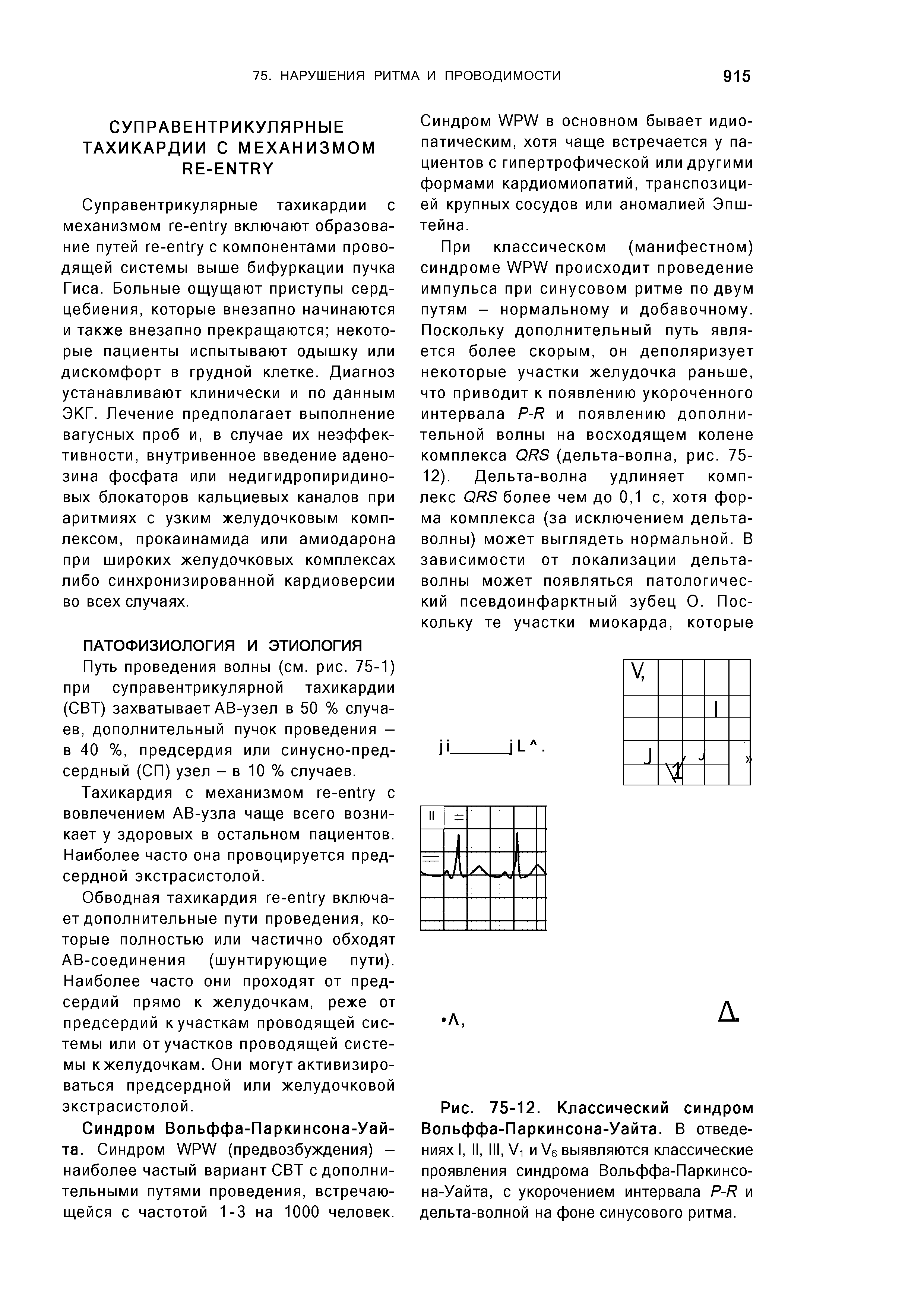 Рис. 75-12. Классический синдром Вольффа-Паркинсона-Уайта. В отведениях I, II, III, V- и V6 выявляются классические проявления синдрома Вольффа-Паркинсо-на-Уайта, с укорочением интервала P-R и дельта-волной на фоне синусового ритма.