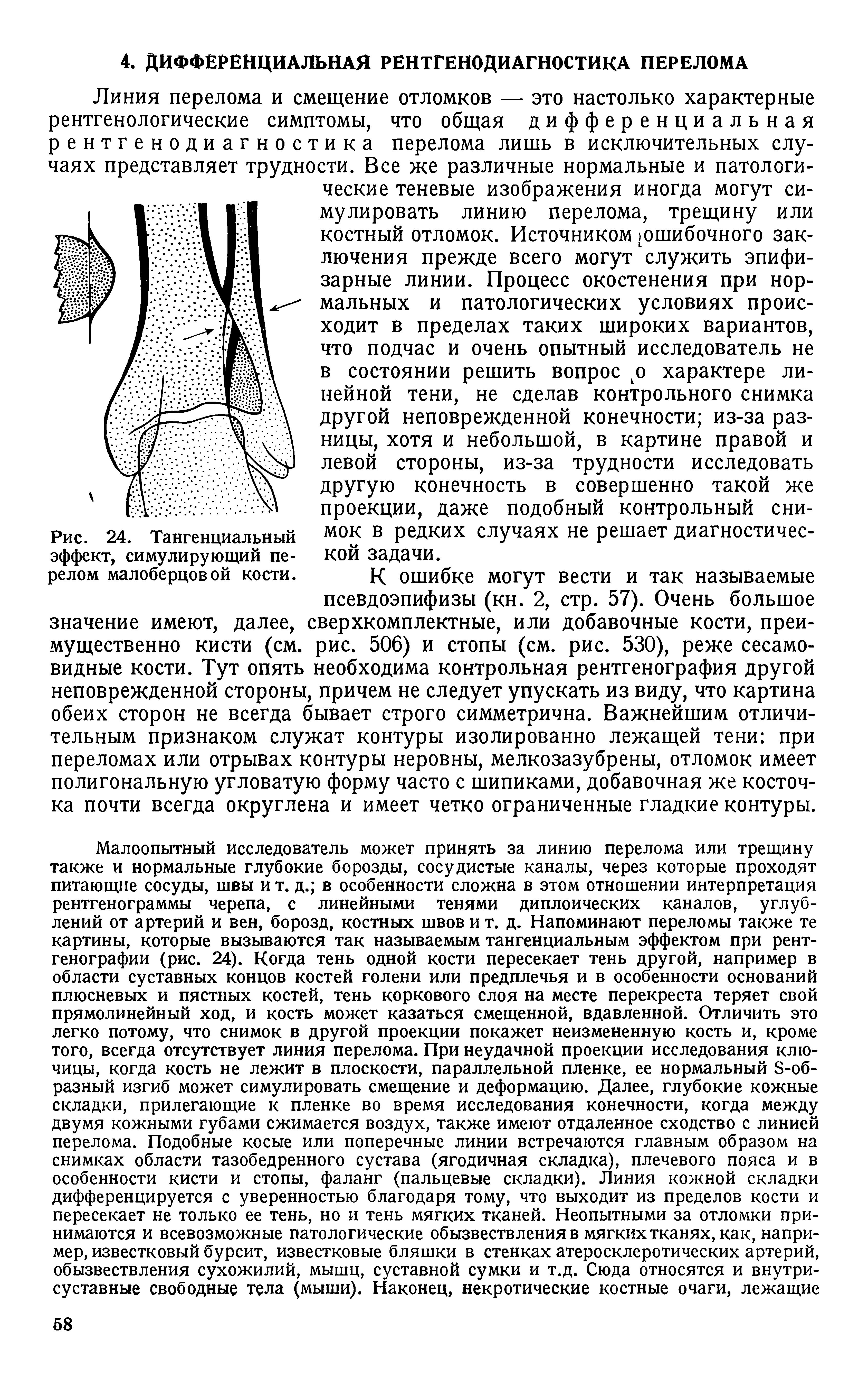 Рис. 24. Тангенциальный эффект, симулирующий перелом малоберцовой кости.