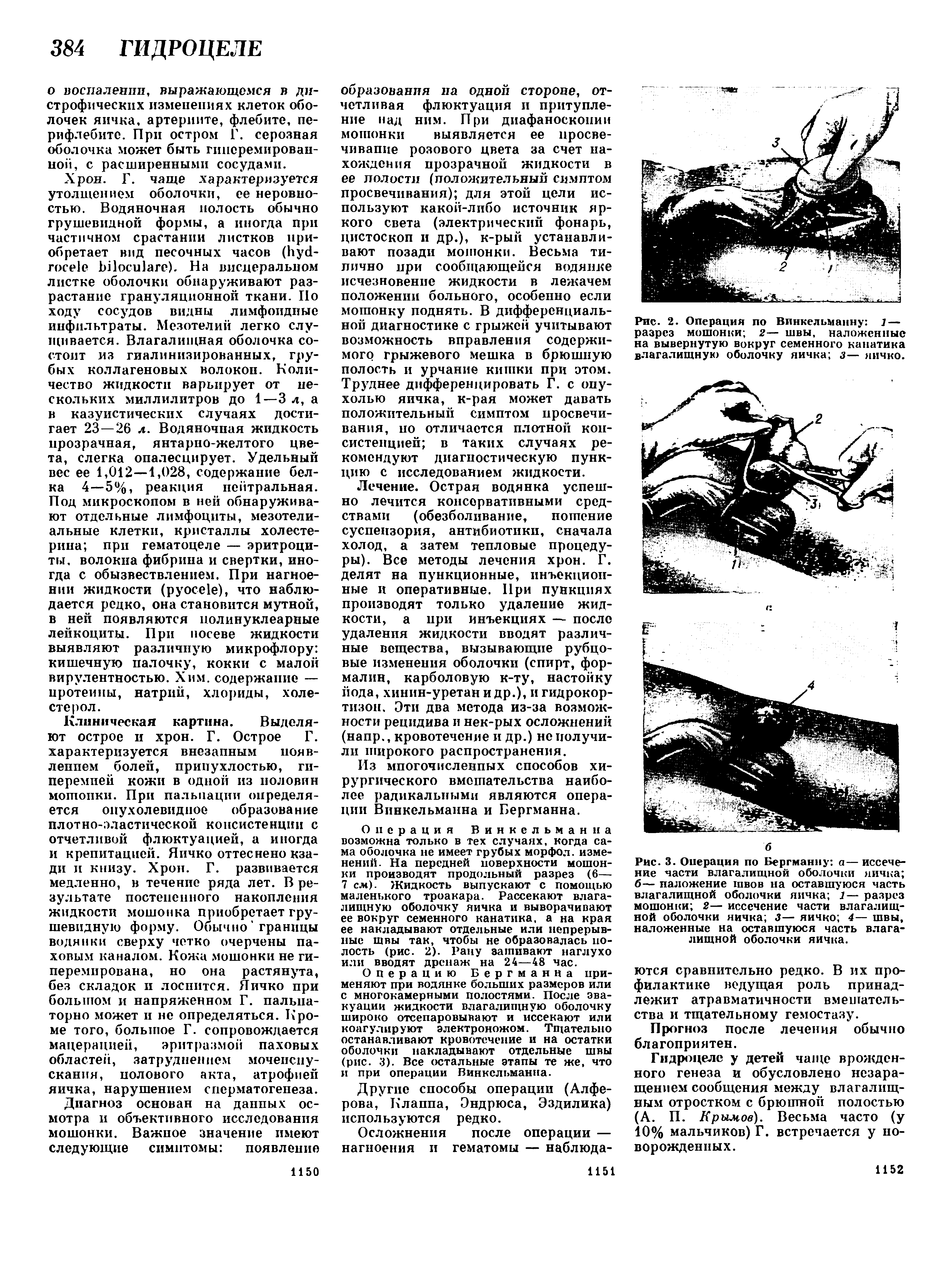 Рис. 2. Операция по Винкельманну ] — разрез мошонки 2— швы, наложенные на вывернутую вокруг семенного канатика влагалищную оболочку яичка з— яичко.