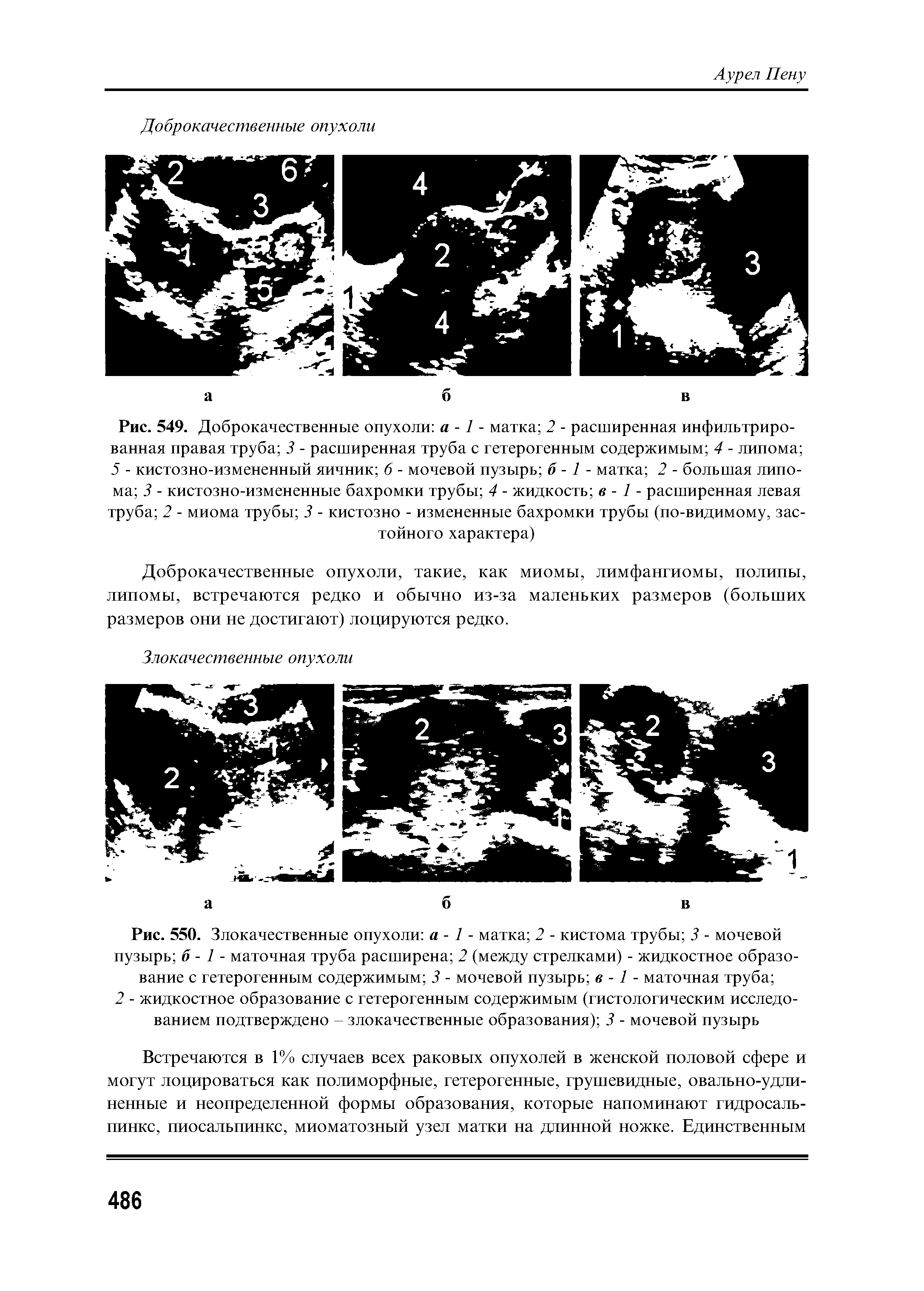 Рис. 550. Злокачественные опухоли а - 1 - матка 2 - кистома трубы 3 - мочевой пузырь б - 1 - маточная труба расширена 2 (между стрелками) - жидкостное образование с гетерогенным содержимым 3 - мочевой пузырь в -1 - маточная труба ...