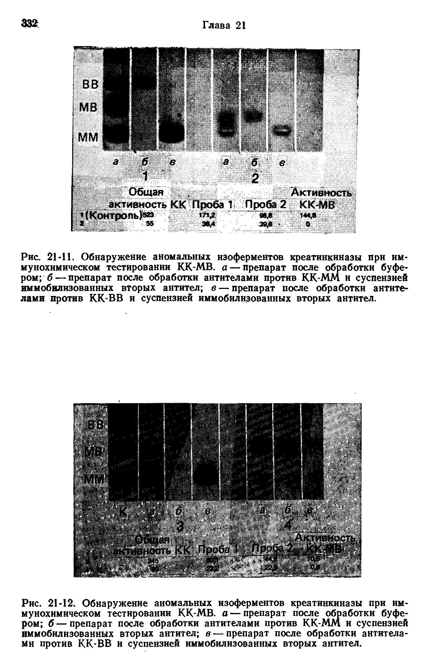 Рис. 21-11. Обнаружение аномальных изоферментов креатинкиназы при им-мунохимическом тестировании КК-МВ. а — препарат после обработки буфером б— препарат после обработки антителами против КК-ММ и суспензией иммобилизованных вторых антител в — препарат после обработки антителами против КК-ВВ и суспензией иммобилизованных вторых антител.