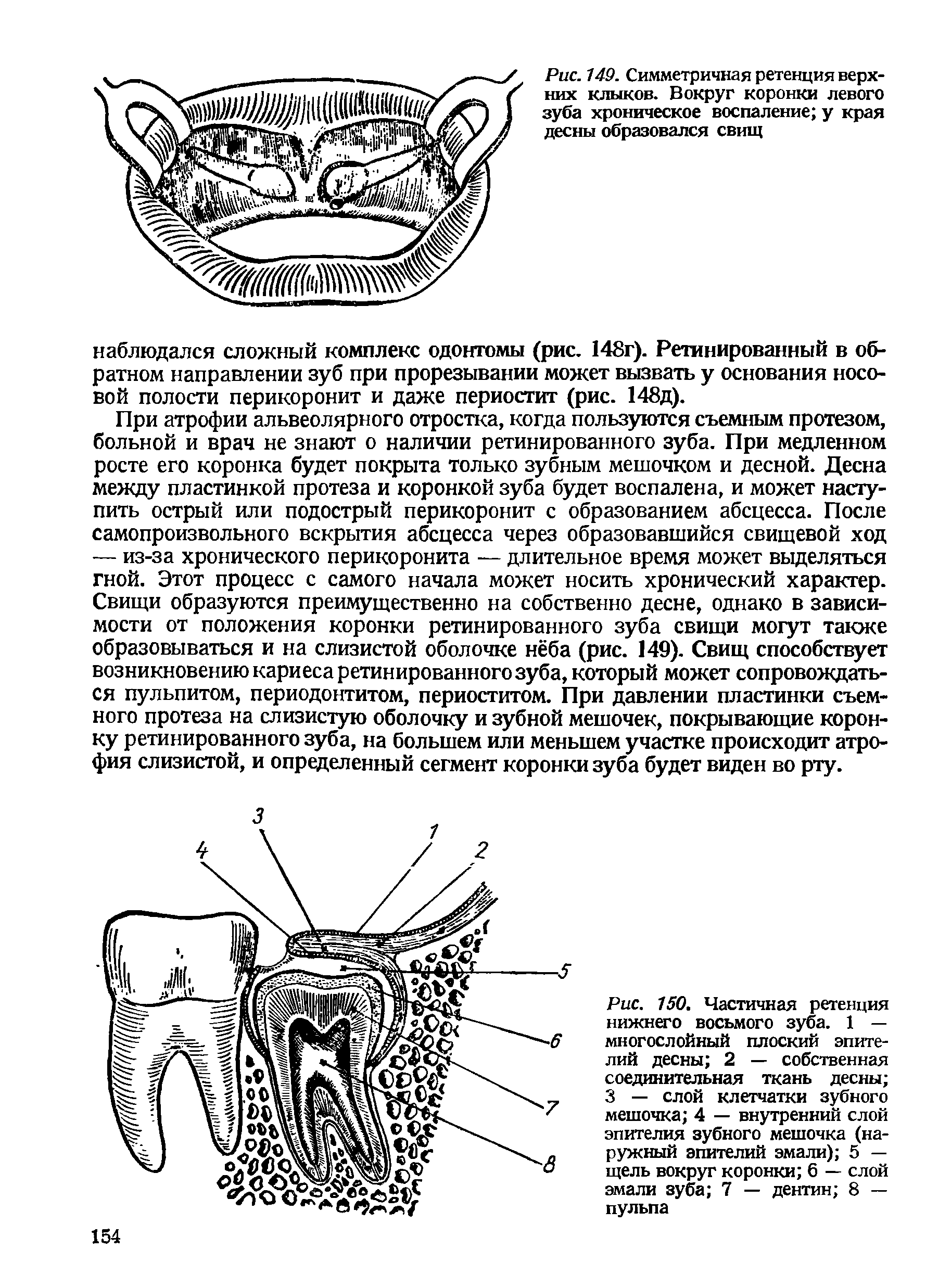 Рис. 150. Частичная ретенция нижнего восьмого зуба. 1 — многослойный плоский эпителий десны 2 — собственная соединительная ткань десны 3 — слой клетчатки зубного мешочка 4 — внутренний слой эпителия зубного мешочка (наружный эпителий эмали) 5 — щель вокруг коронки б — слой эмали зуба 7 — дентин 8 — пульпа...