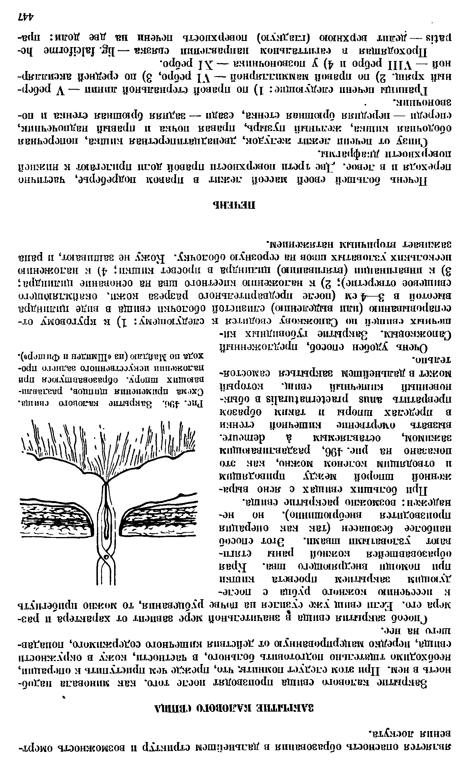 Рис. 436. Закрытие калового свища. Схема применения щипцов, раздавливающих шпору, образовавшуюся при наложении искусственного заднего прохода по Майдлю (из Шмпден и Фишер ),...