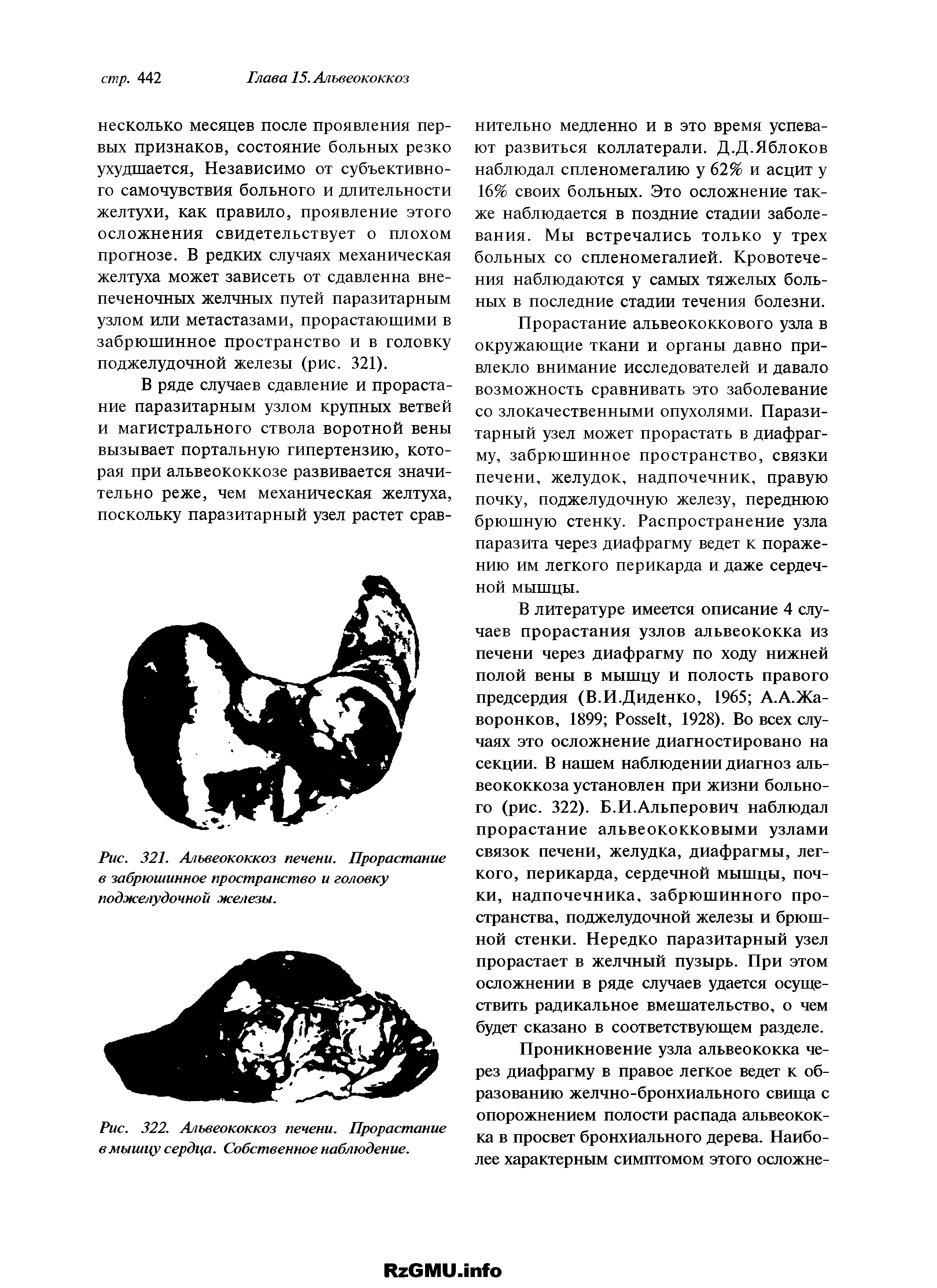 Рис. 322. Альвеококкоз печени. Прорастание в мышцу сердца. Собственное наблюдение.