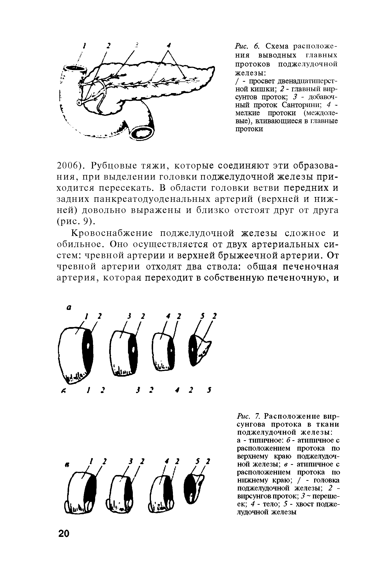 Рис. 7. Расположение вир-сунгова протока в ткани поджелудочной железы а - типичное б - атипичное с расположением протока по верхнему краю поджелудочной железы в - атипичное с расположением протока по нижнему краю / - головка поджелудочной железы 2 -вирсунгов проток 3 перешеек 4 - тело 5 - хвост поджелудочной железы...