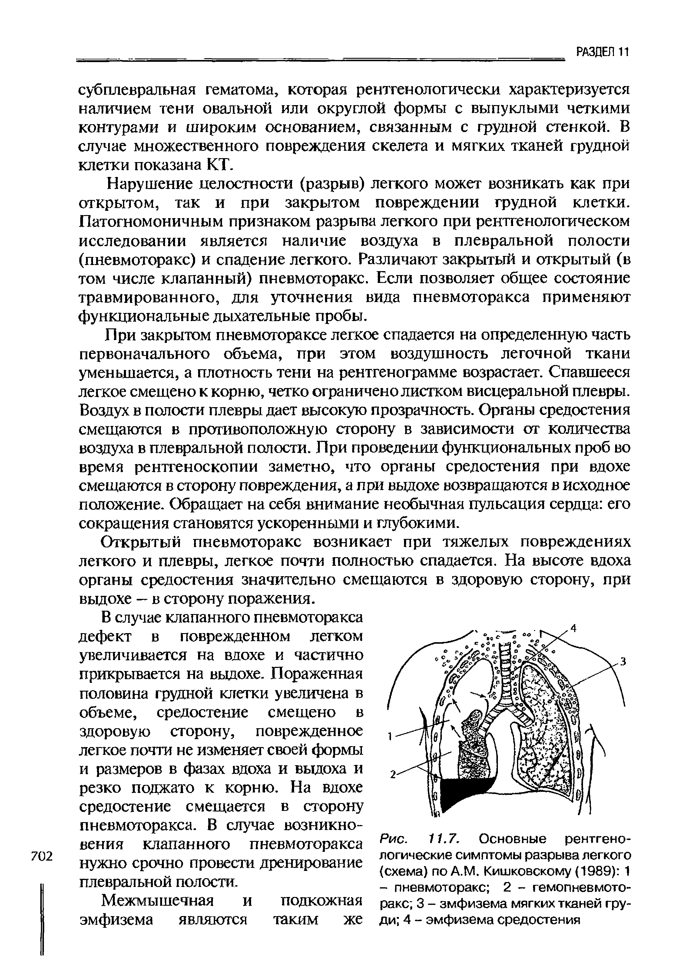 Рис. 11.7. Основные рентгенологические симптомы разрыва легкого схема) по А.М. Кишковскому (1989) 1 - пневмоторакс 2 - гемопневмоторакс 3 - эмфизема мягких тканей груди 4 - эмфизема средостения...