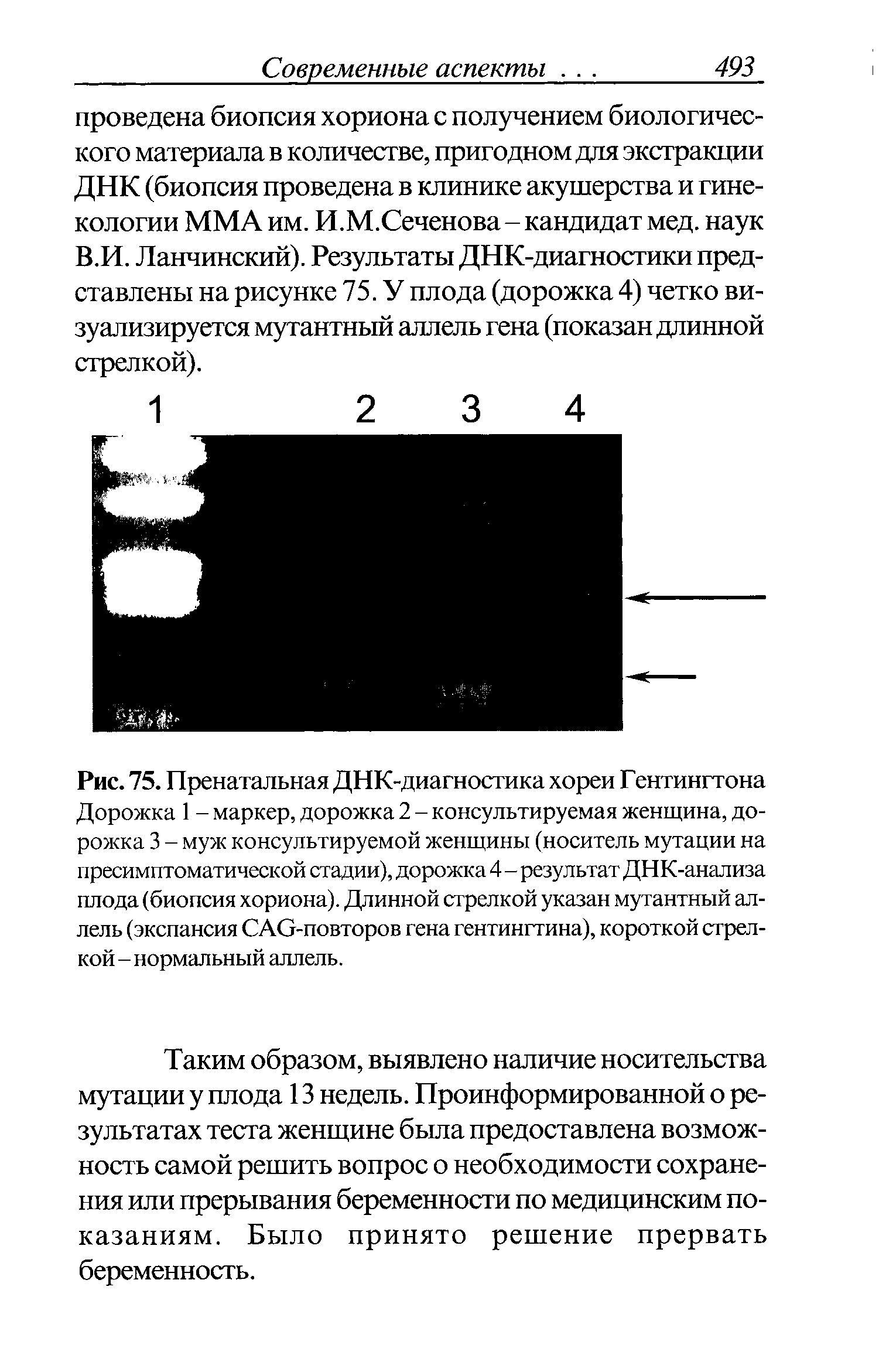 Рис. 75. Пренатальная ДНК-диагностика хореи Гентингтона Дорожка 1 - маркер, дорожка 2 - консультируемая женщина, дорожка 3 - муж консультируемой женщины (носитель мутации на пресимптоматической стадии), дорожка 4 - результат ДНК-анализа плода (биопсия хориона). Длинной стрелкой указан мутантный аллель (экспансия САО-повторов гена гентингтина), короткой стрелкой - нормальный аллель.