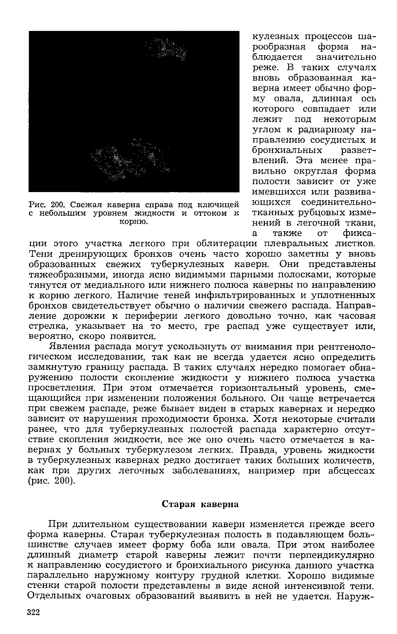 Рис. 200. Свежая каверна справа под ключицей ющихся соединительно-с небольшим уровнем жидкости и оттоком к тканных рубцовых изме-корню. нений в легочной ткани,...