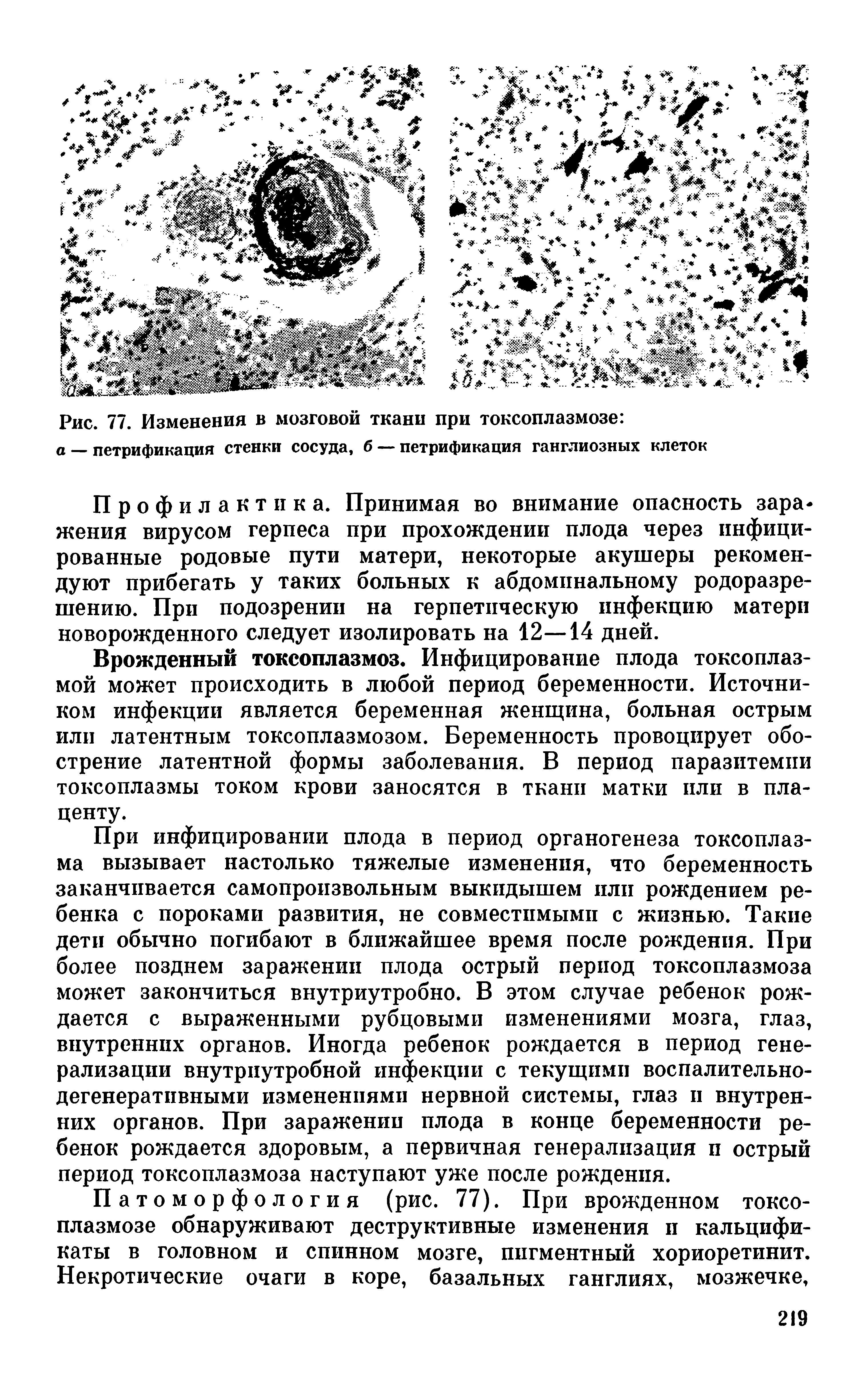 Рис. 77. Изменения в мозговой ткани при токсоплазмозе а — петрификация стенки сосуда, б — петрификация ганглиозных клеток...