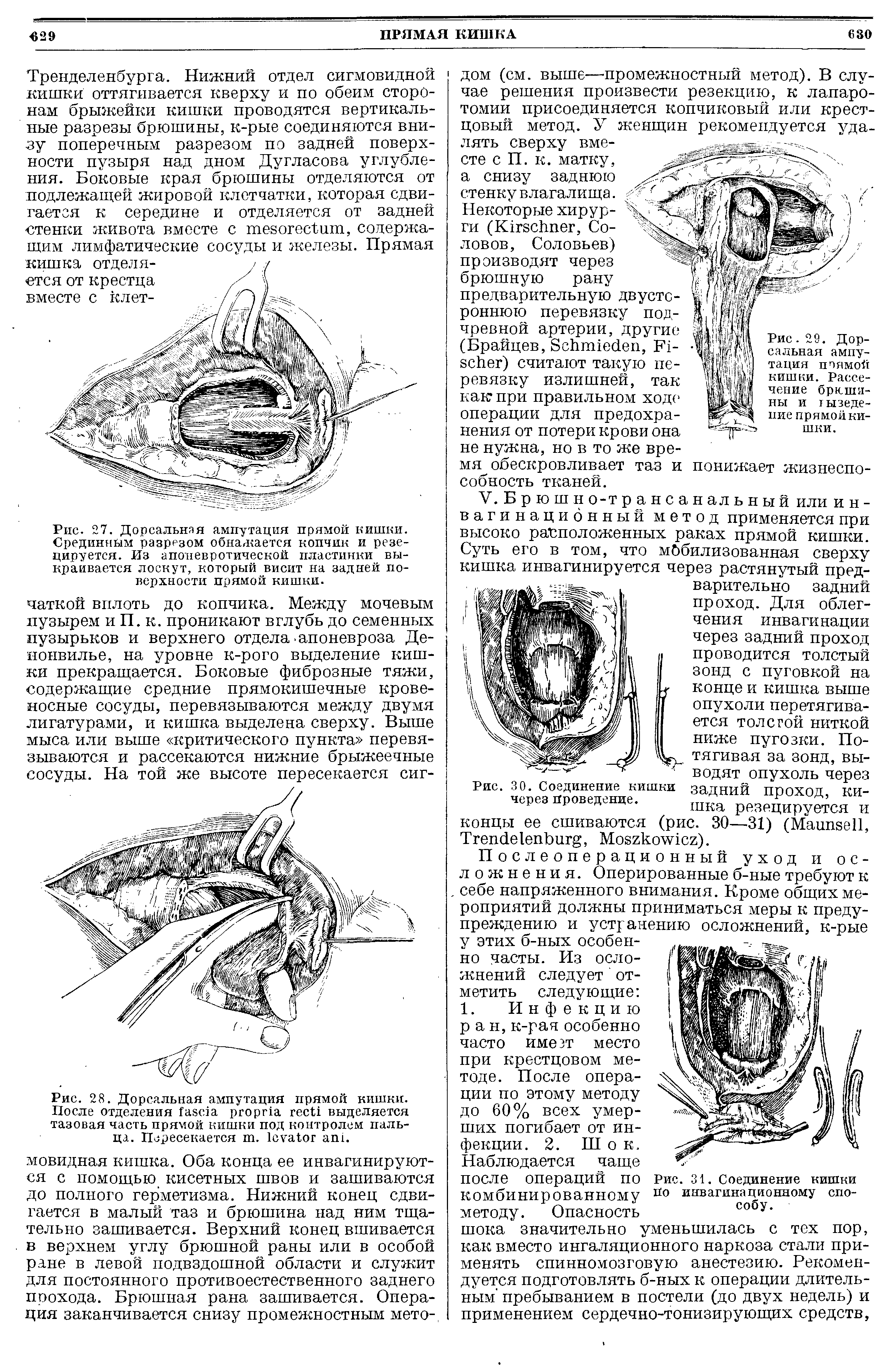 Рис. 30. Соединение кишки задний проход, КИ-через Проведение. тттт, н...