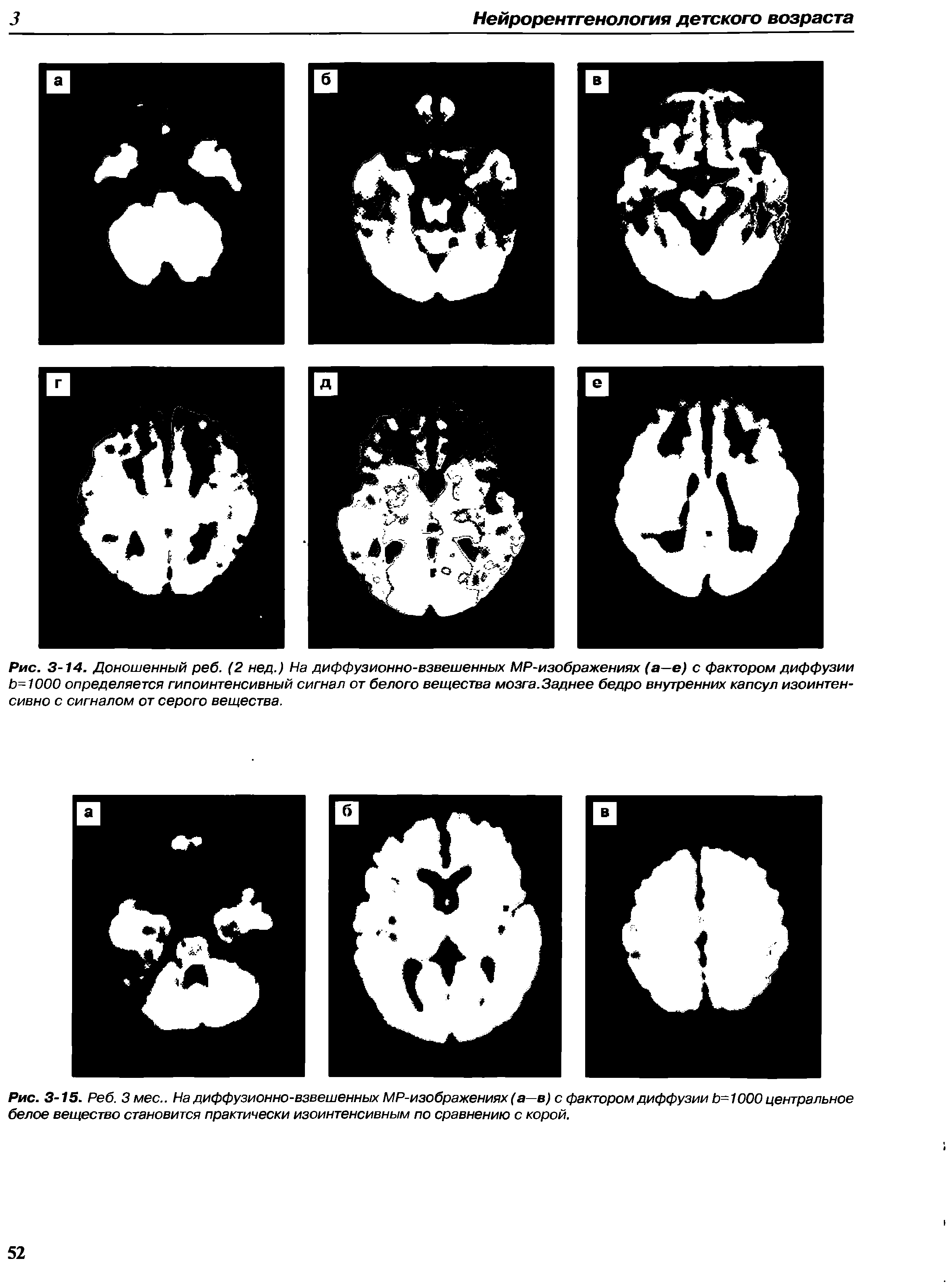Рис. 3-15. Реб. Змее.. На диффузионно-взвешенных МР-изображениях (а—в) с фактором диффузии Ь=1 ООО центральное белое вещество становится практически изоинтенсивным по сравнению с корой.