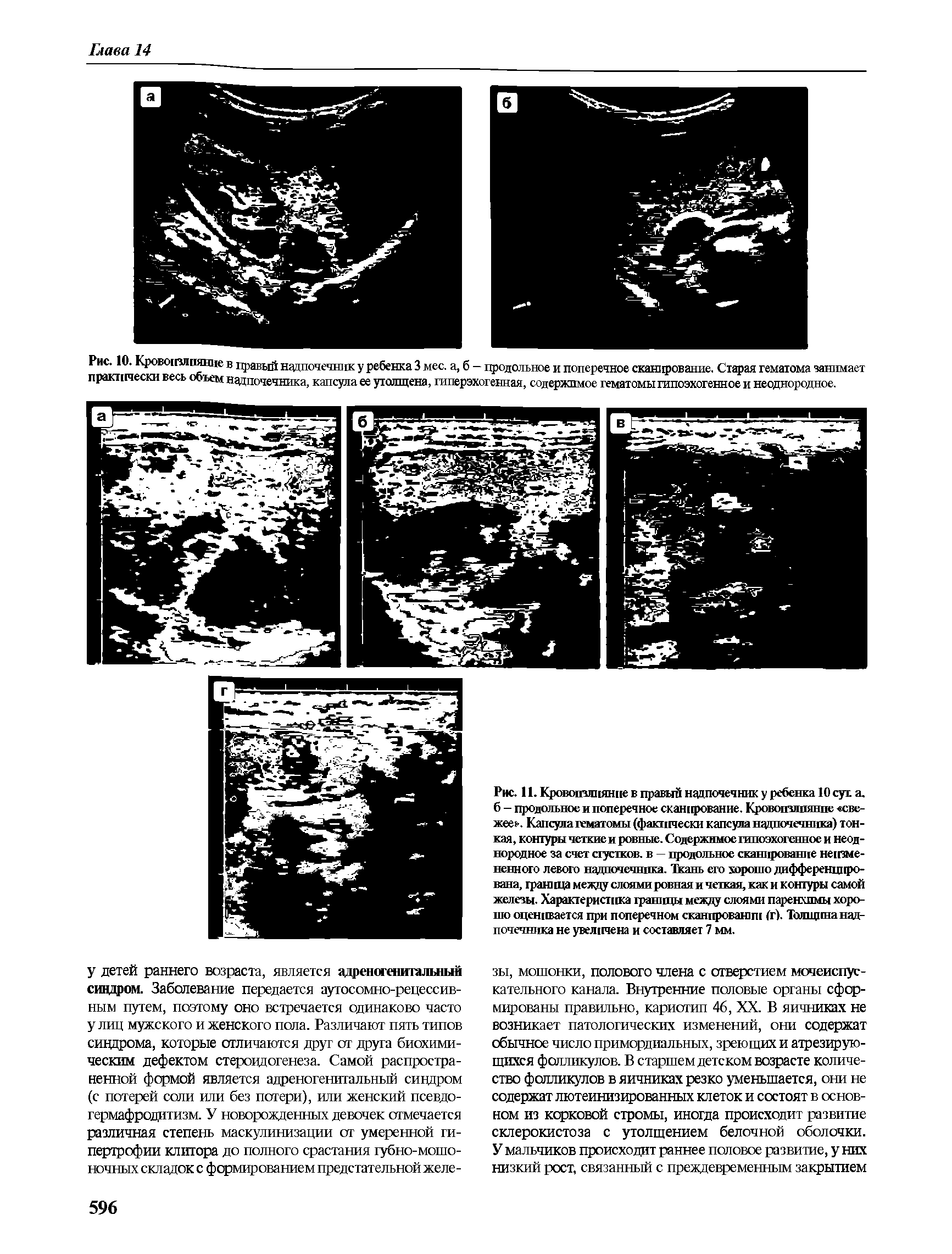 Рис. 10. Кровоизлияние в правый надпочечник у ребенка 3 мес. а, б — продольное и поперечное сканирование. Старая гематома занимает практически весь объем надпочечника, капсула ее утолщена, гиперэхогенная, содержимое гематомы типоэхогенное и неоднородное.