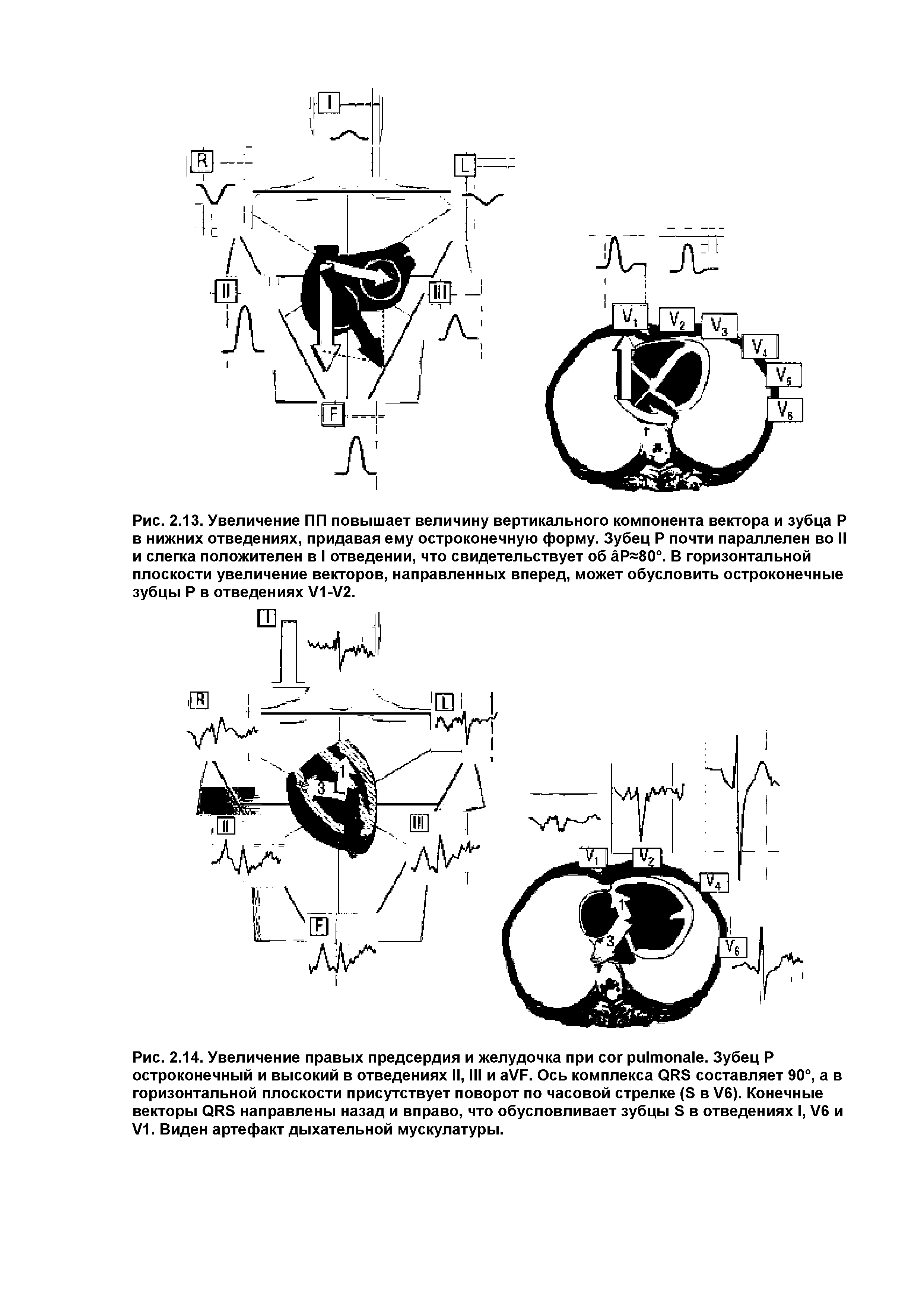 Рис. 2.14. Увеличение правых предсердия и желудочка при . Зубец Р остроконечный и высокий в отведениях II, III и VF. Ось комплекса QRS составляет 90°, а в горизонтальной плоскости присутствует поворот по часовой стрелке (S в V6). Конечные векторы QRS направлены назад и вправо, что обусловливает зубцы S в отведениях I, V6 и V1. Виден артефакт дыхательной мускулатуры.