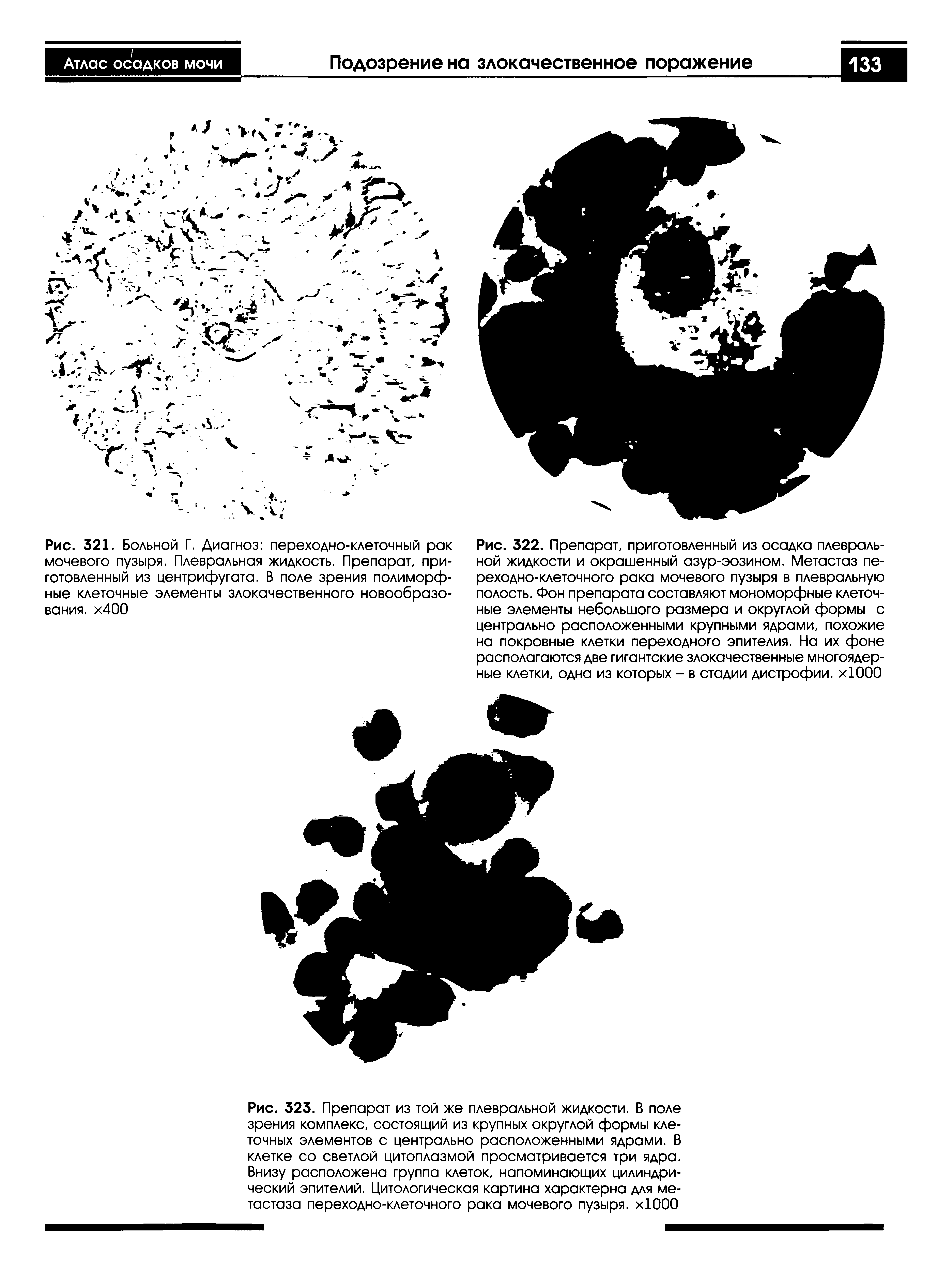 Рис. 321. Больной Г. Диагноз переходно-клеточный рак мочевого пузыря. Плевральная жидкость. Препарат, приготовленный из центрифугата. В поле зрения полиморфные клеточные элементы злокачественного новообразования. х400...