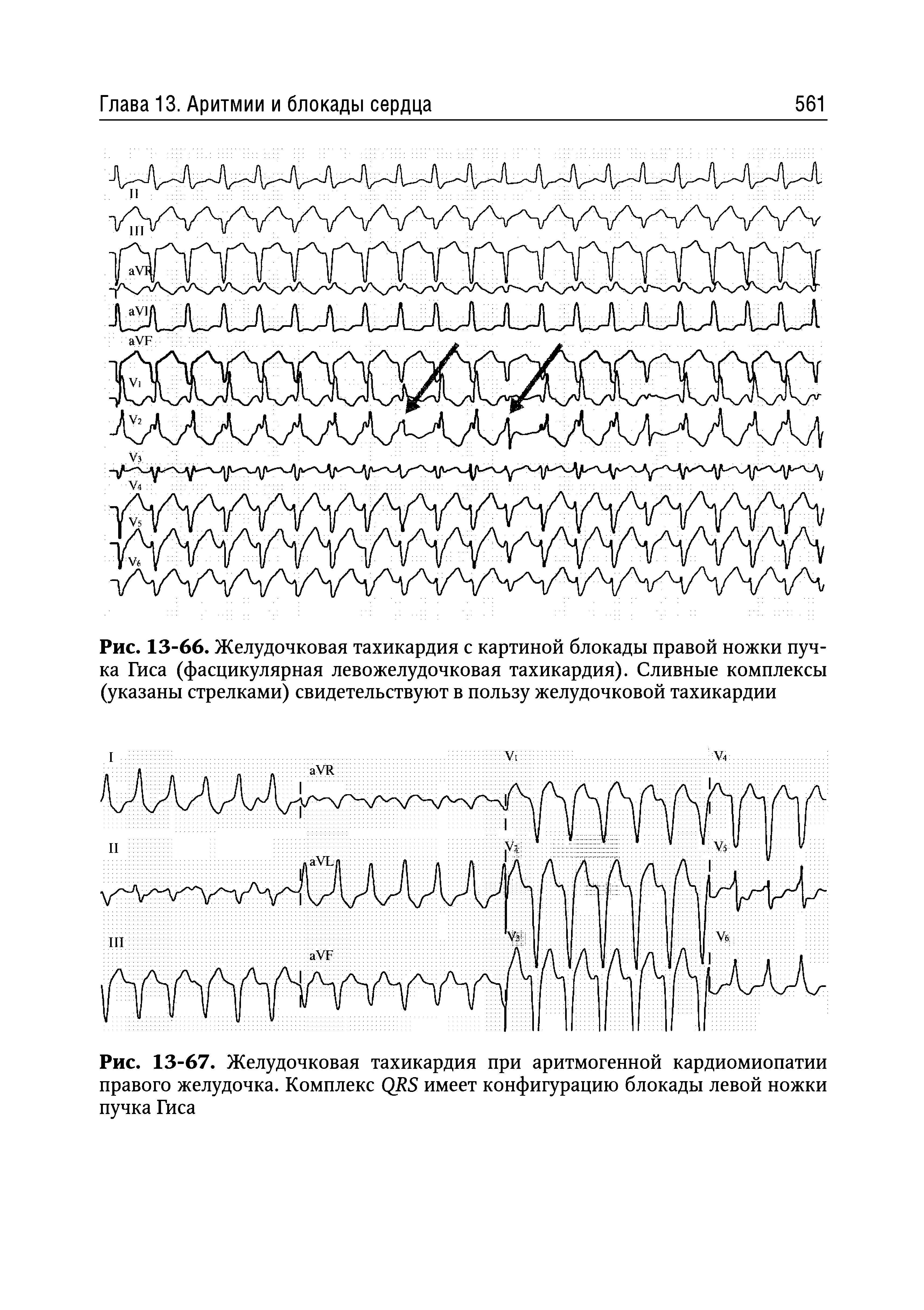 Рис. 13-66. Желудочковая тахикардия с картиной блокады правой ножки пучка Гиса (фасцикулярная левожелудочковая тахикардия). Сливные комплексы (указаны стрелками) свидетельствуют в пользу желудочковой тахикардии...