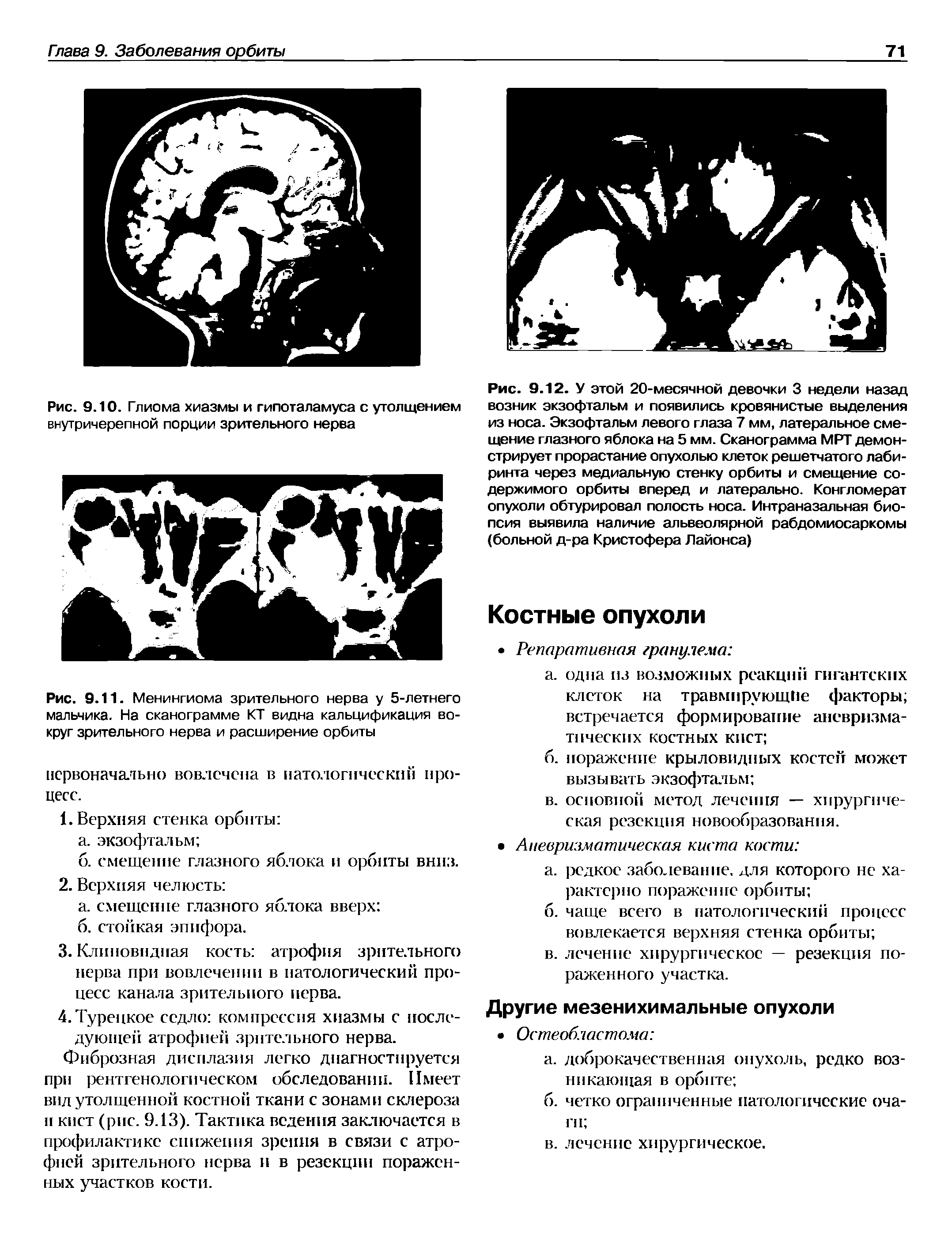 Рис. 9.11. Менингиома зрительного нерва у 5-летнего мальчика. На сканограмме КТ видна кальцификация вокруг зрительного нерва и расширение орбиты...