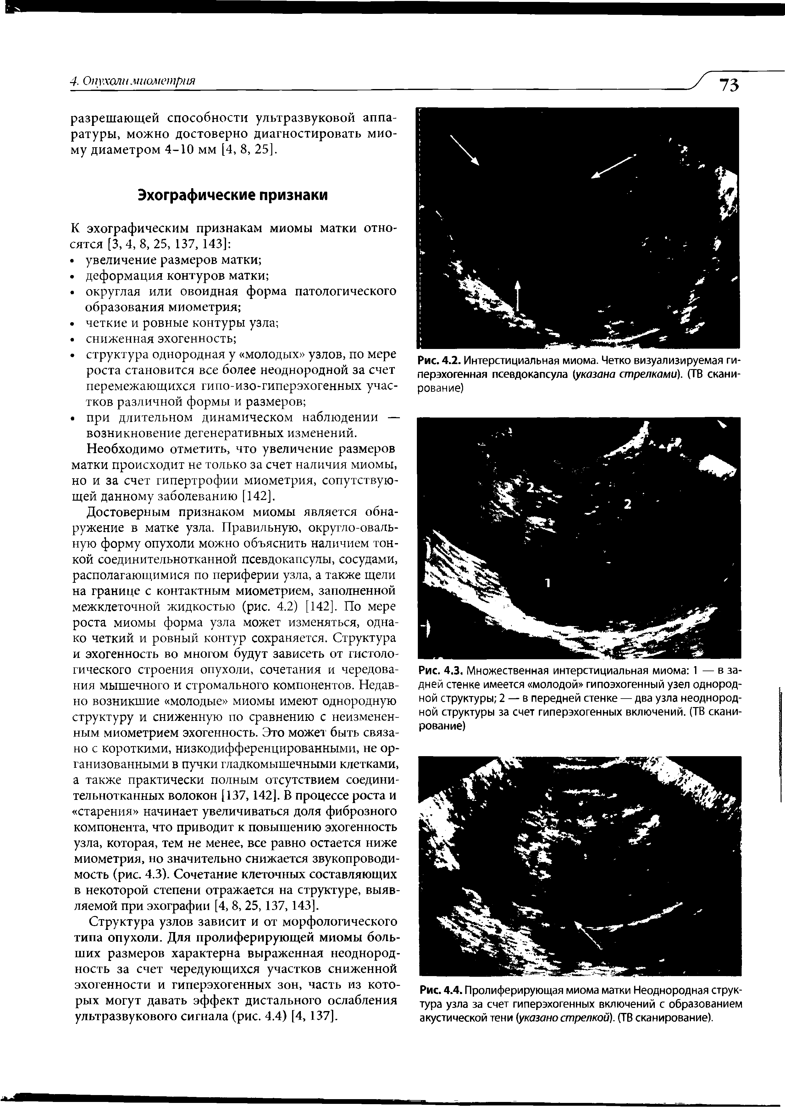 Рис. 4.4. Пролиферирующая миома матки Неоднородная структура узла за счет гиперэхогенных включений с образованием акустической тени (указанострелкой. (ТВ сканирование).