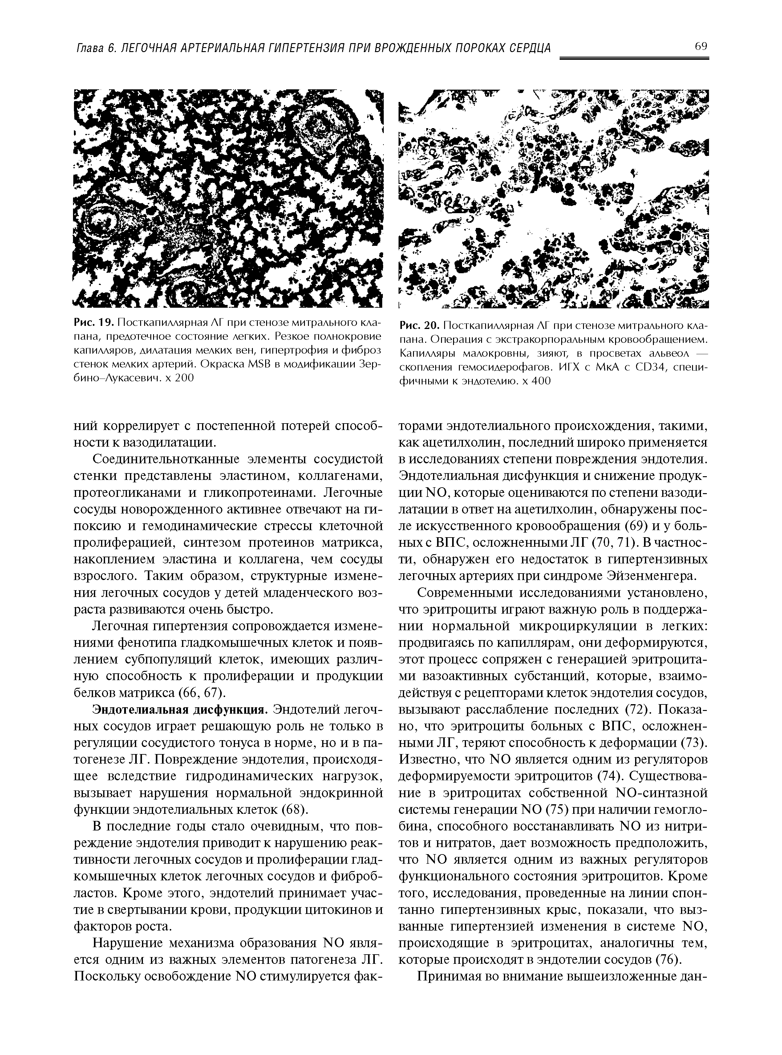 Рис. 20. Посткапиллярная АГ при стенозе митрального клапана. Операция с экстракорпоральным кровообращением. Капилляры малокровны, зияют, в просветах альвеол — скопления гемосидерофагов. ИГХ с МкА с СЮ34, специфичными к эндотелию, х 400...