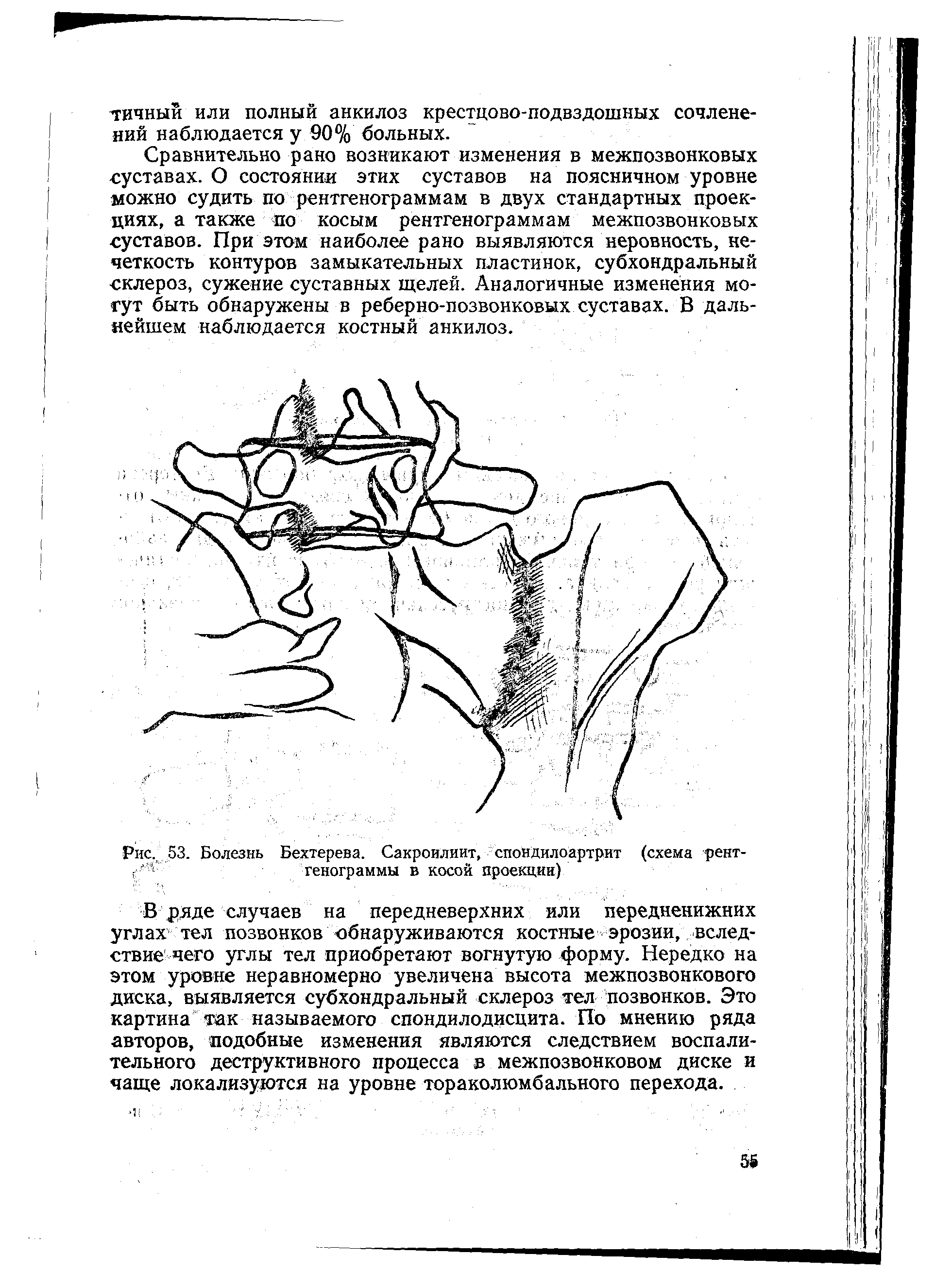 Рис. 53. Болезнь Бехтерева. Сакроилиит, спондилоартрит (схема рент-...