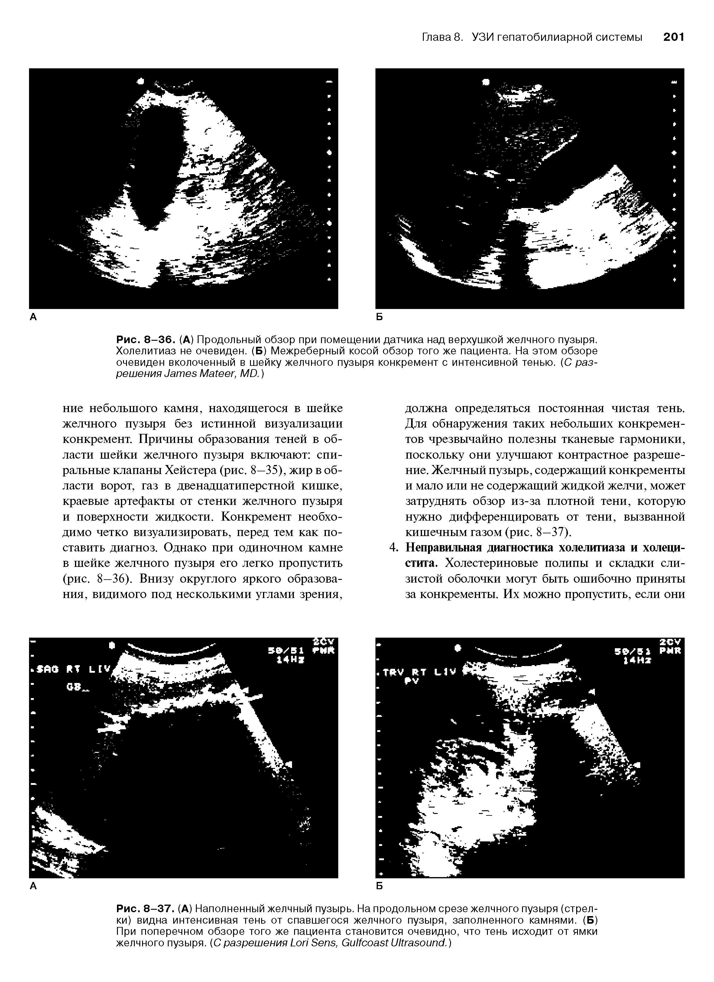 Рис. 8-36. (А) Продольный обзор при помещении датчика над верхушкой желчного пузыря. Холелитиаз не очевиден. (Б) Межреберный косой обзор того же пациента. На этом обзоре очевиден вколоченный в шейку желчного пузыря конкремент с интенсивной тенью. (С разрешения тев Ма(еег МО.)...