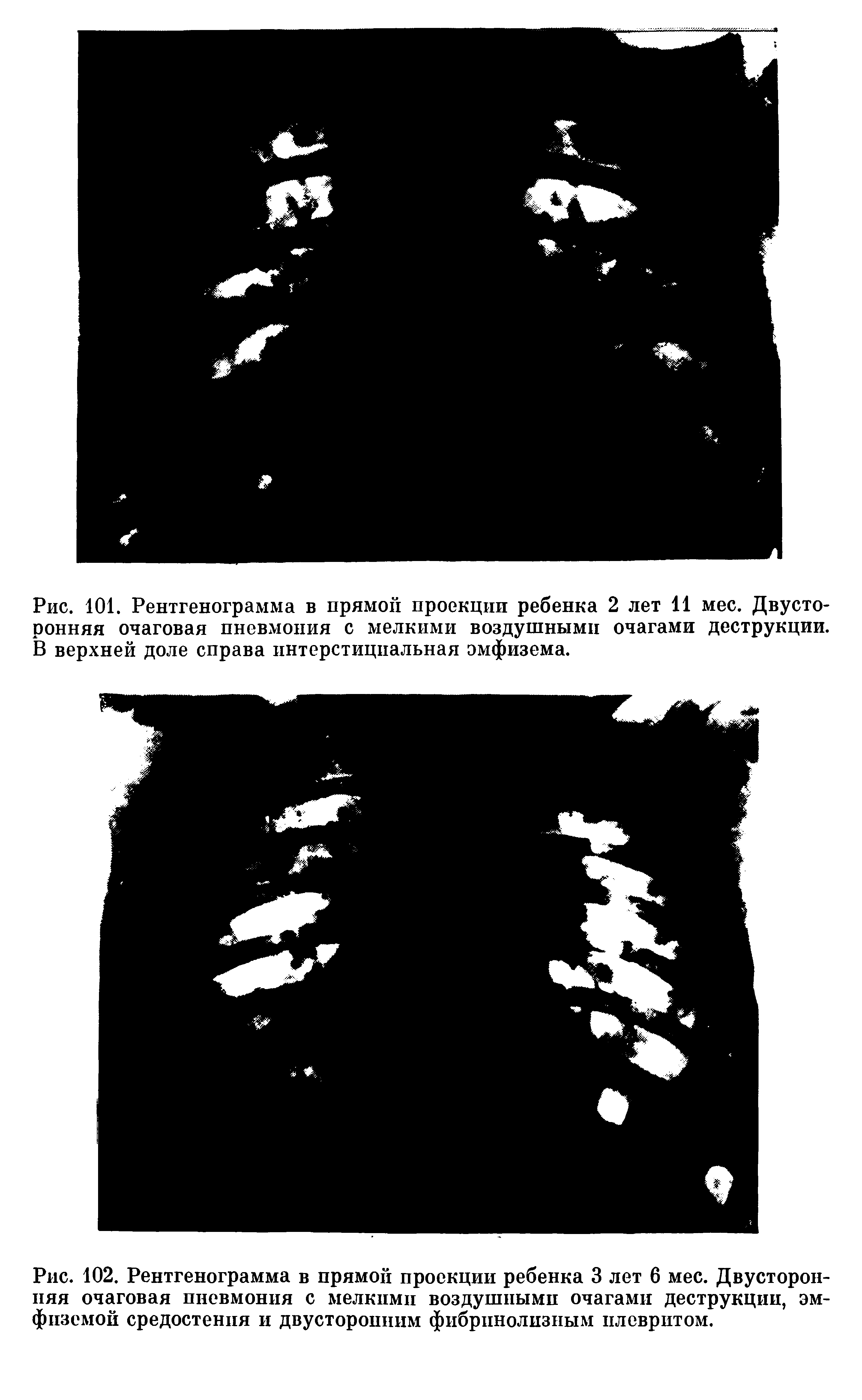 Рис. 102. Рентгенограмма в прямой проекции ребенка 3 лет 6 мес. Двусторонняя очаговая пневмония с мелкими воздушными очагами деструкции, эмфиземой средостения и двусторонним фибрпнолизным плевритом.